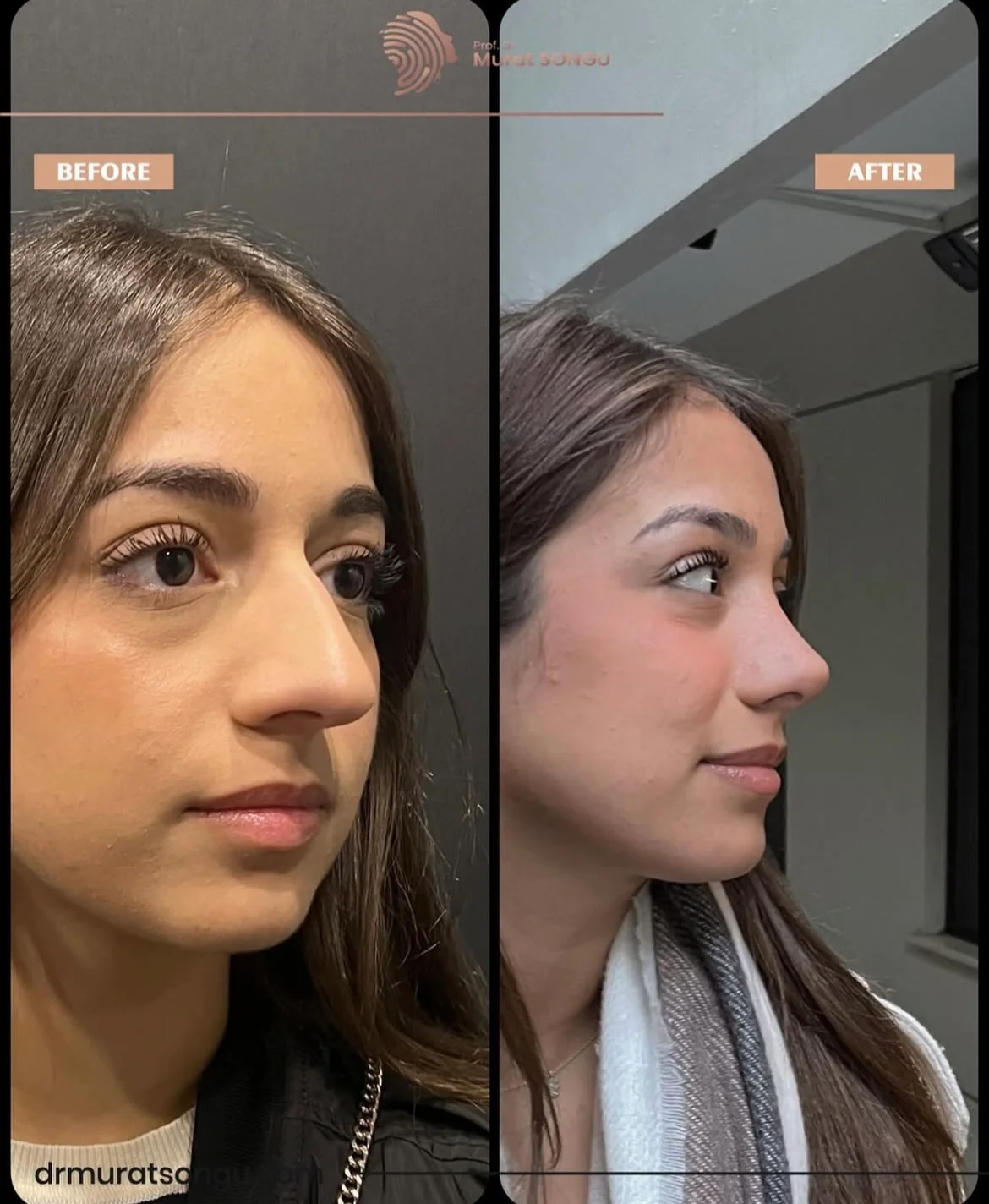 Rhinoplastik Före och Efter Rhinoplastik Före och Efter