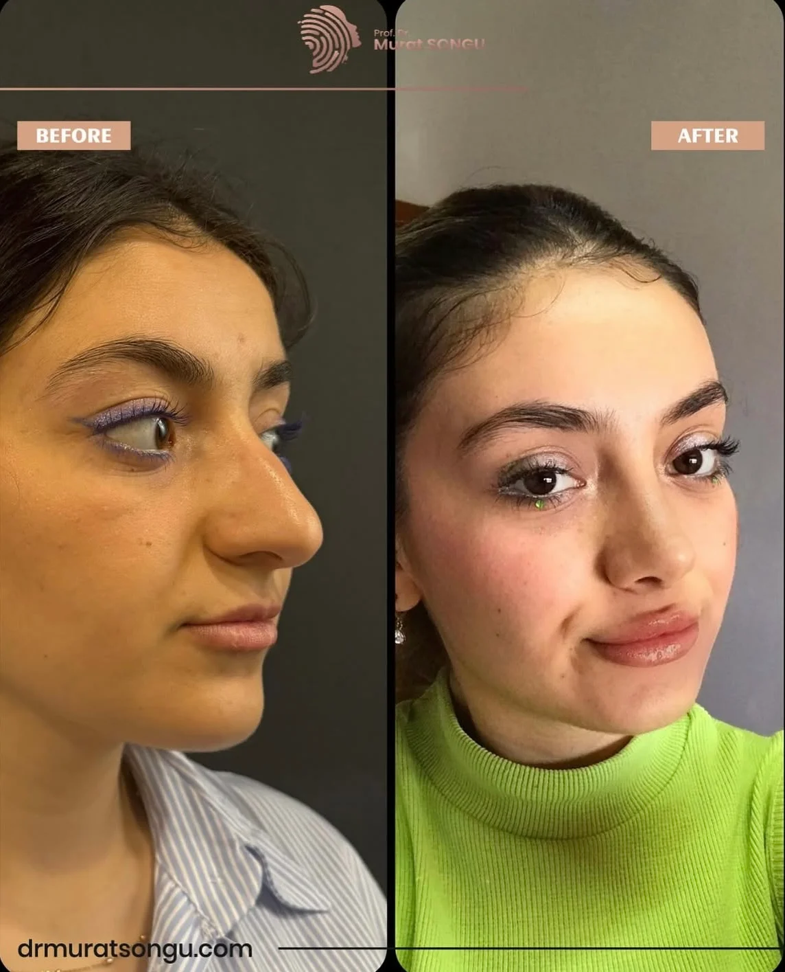 Rhinoplastik Före och Efter Rhinoplastik Före och Efter