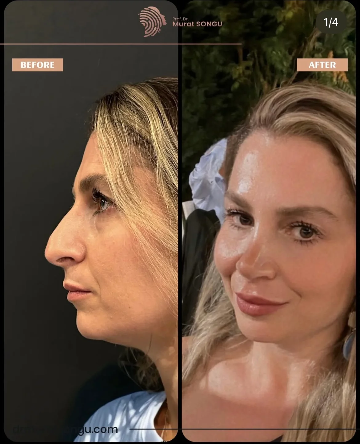 Rhinoplastik Före och Efter Rhinoplastik Före och Efter