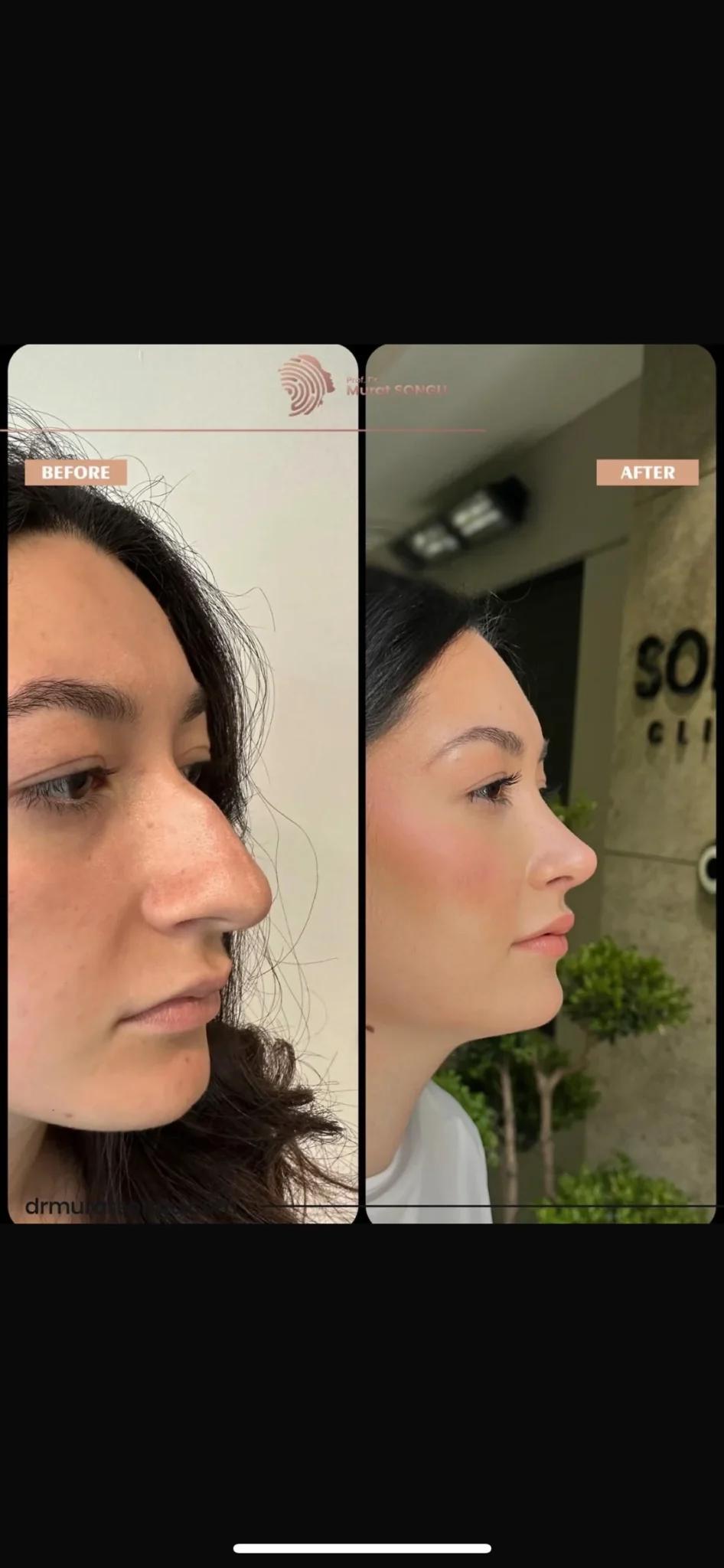Rhinoplastik Före och Efter Rhinoplastik Före och Efter