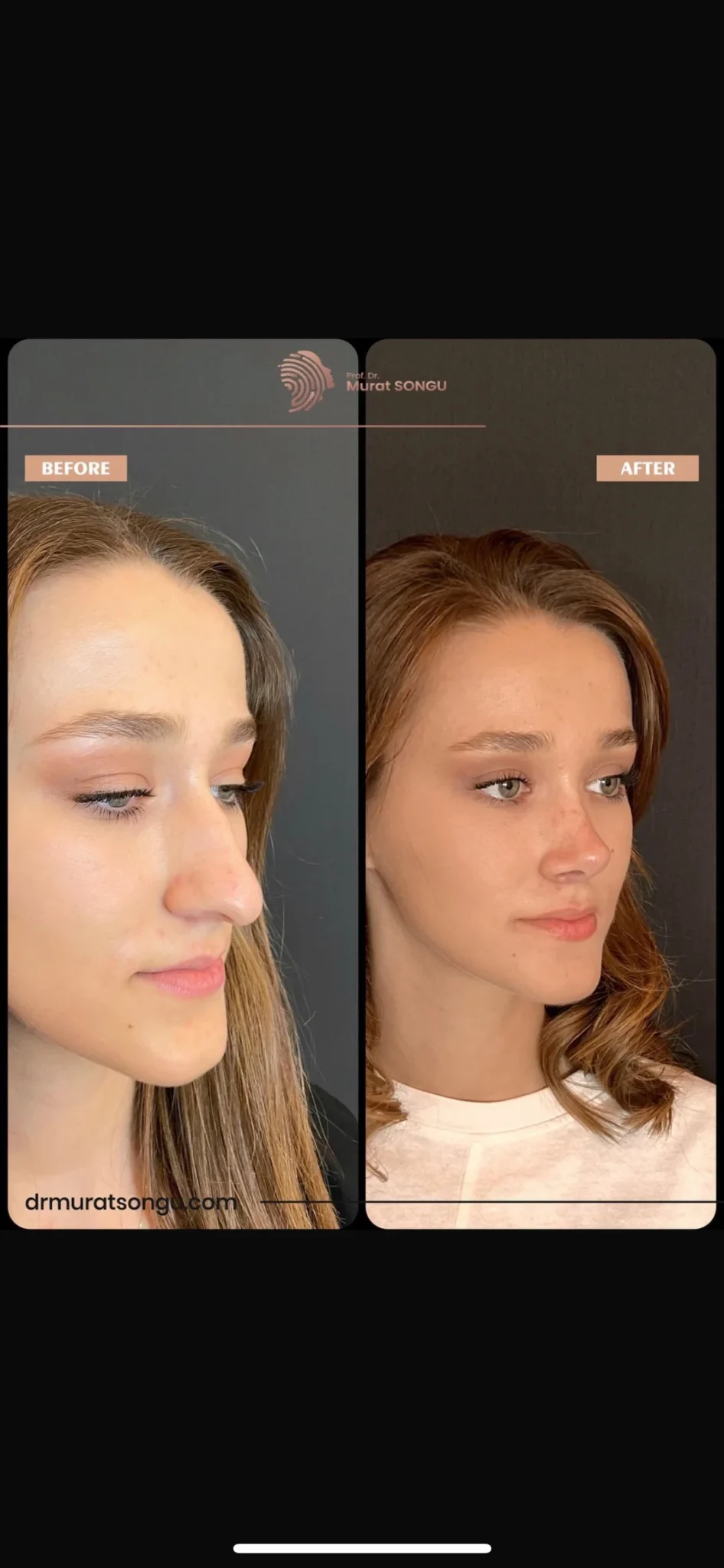 Rhinoplastik Före och Efter Rhinoplastik Före och Efter