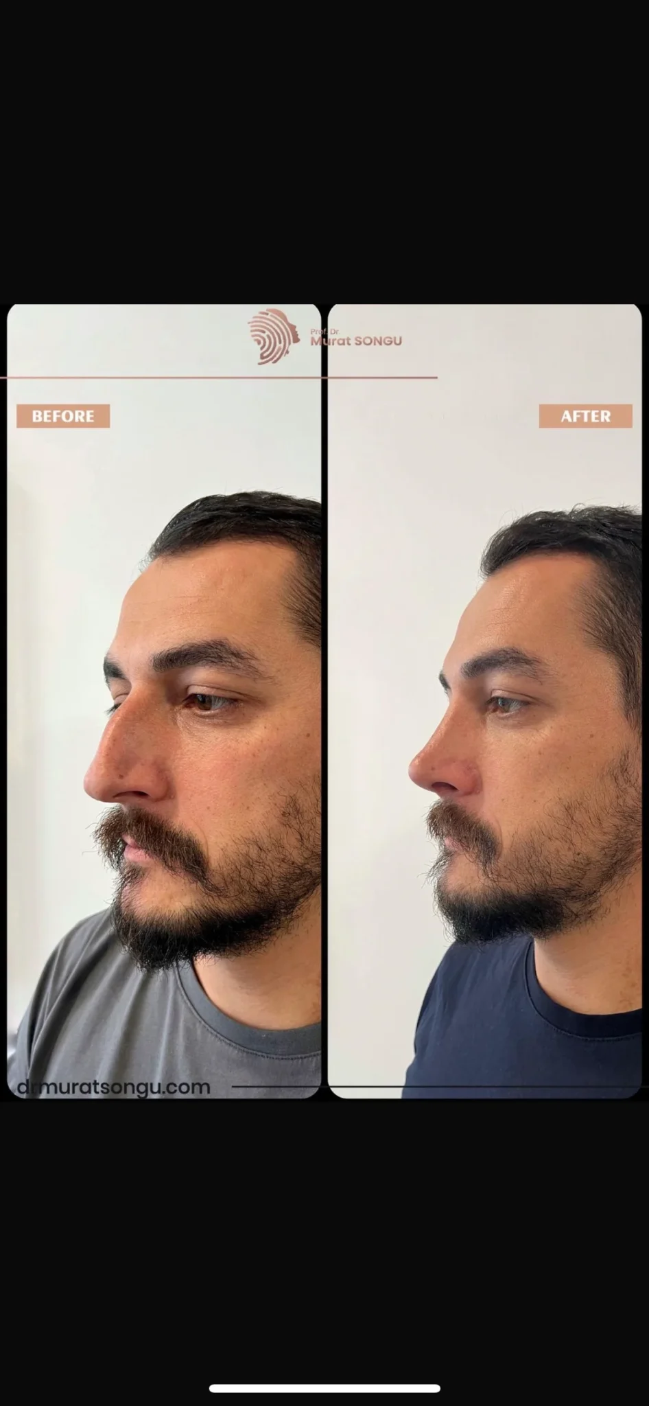 Rhinoplastik Före och Efter Rhinoplastik Före och Efter