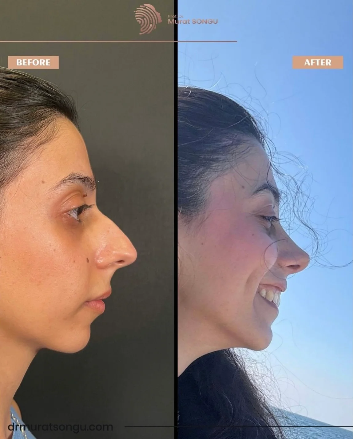 Rhinoplastik Före och Efter Rhinoplastik Före och Efter