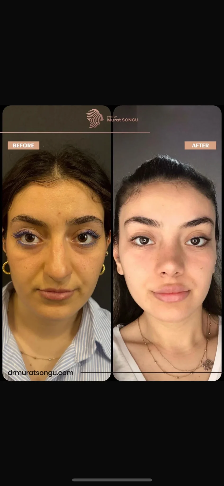 Rhinoplastik Före och Efter Rhinoplastik Före och Efter