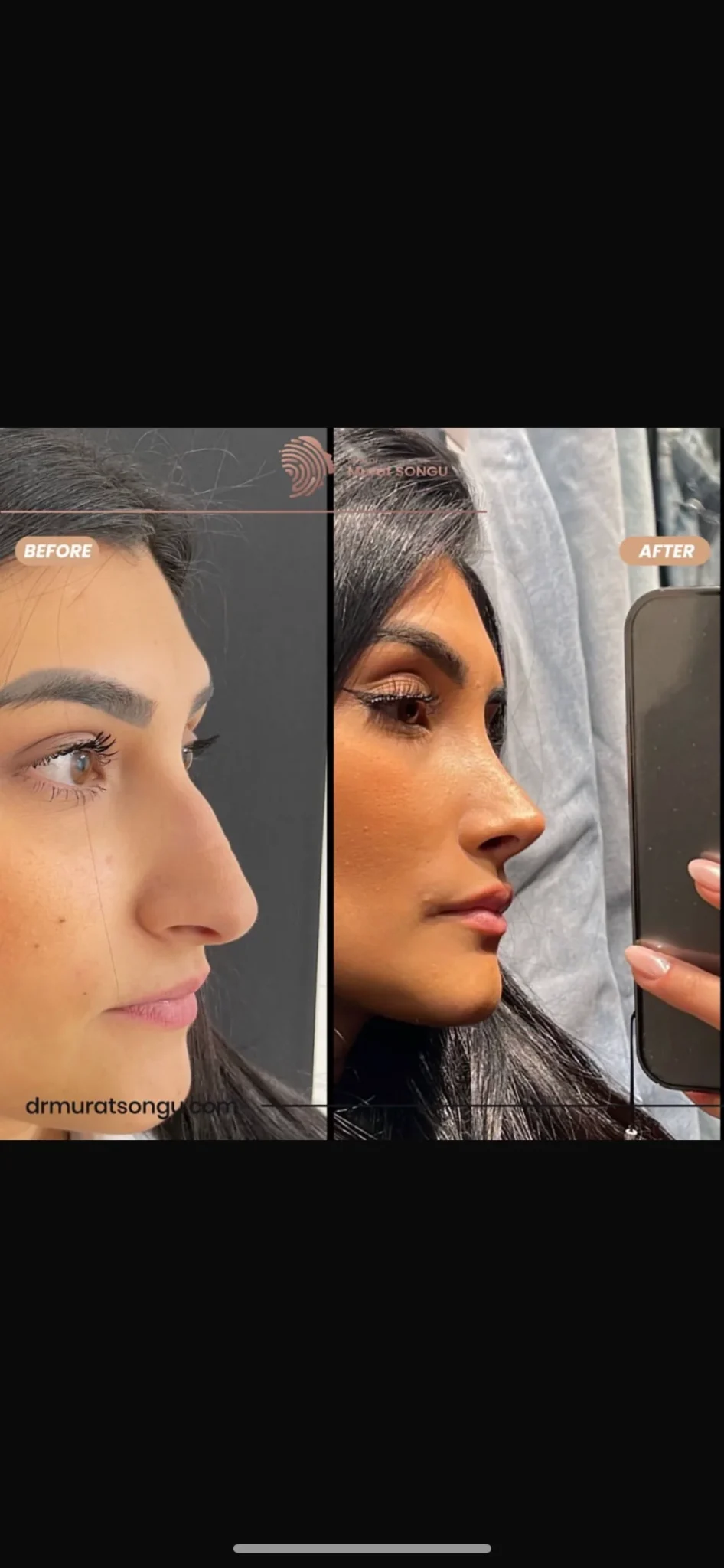 Rhinoplastik Före och Efter Rhinoplastik Före och Efter