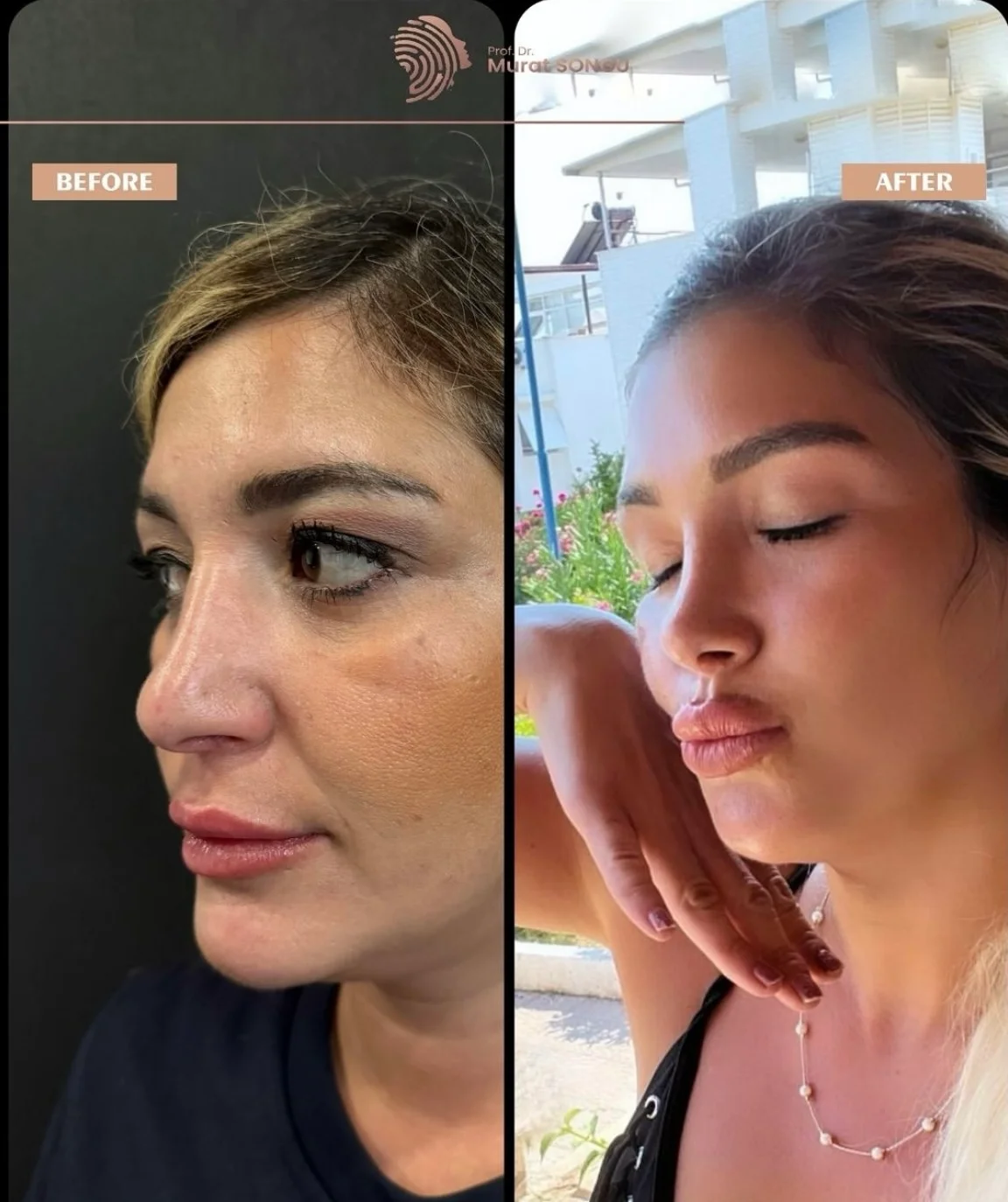 Rhinoplastik Före och Efter Rhinoplastik Före och Efter