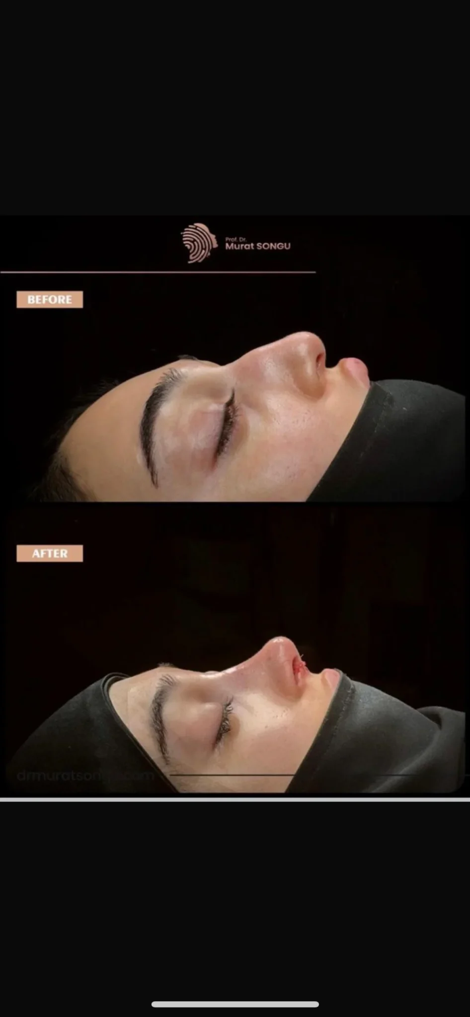 Rhinoplastik för Tjock Hud Före- och Efterbilder