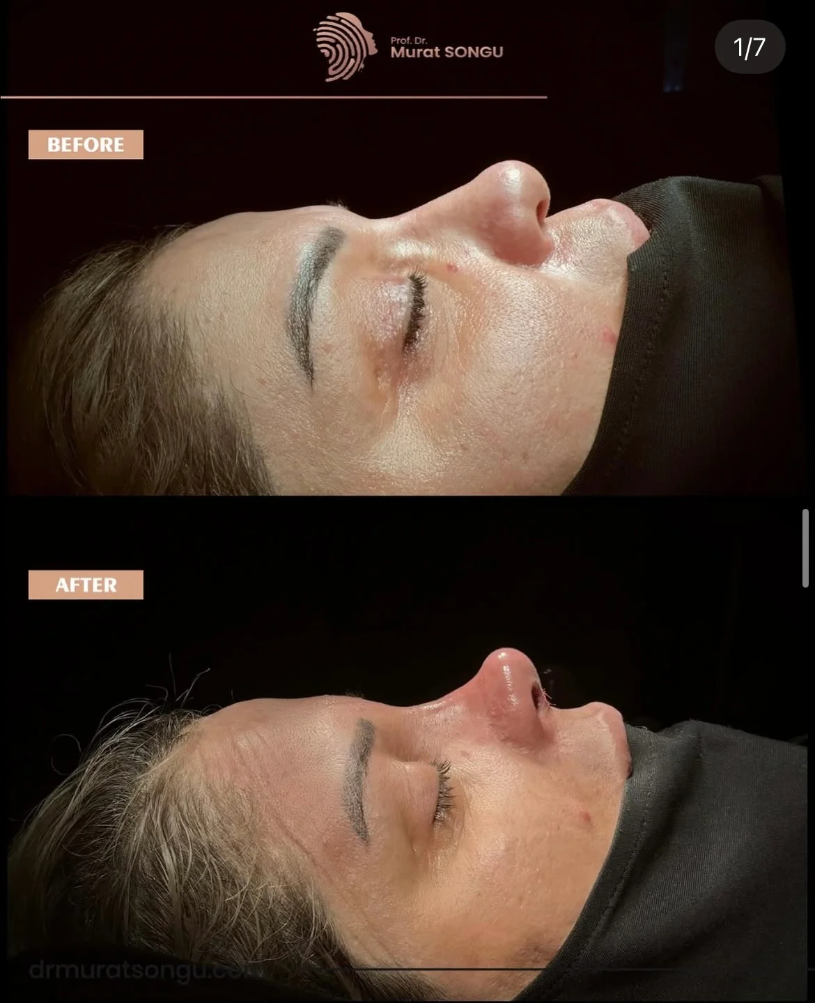 Rhinoplastik för Tjock Hud Före- och Efterbilder