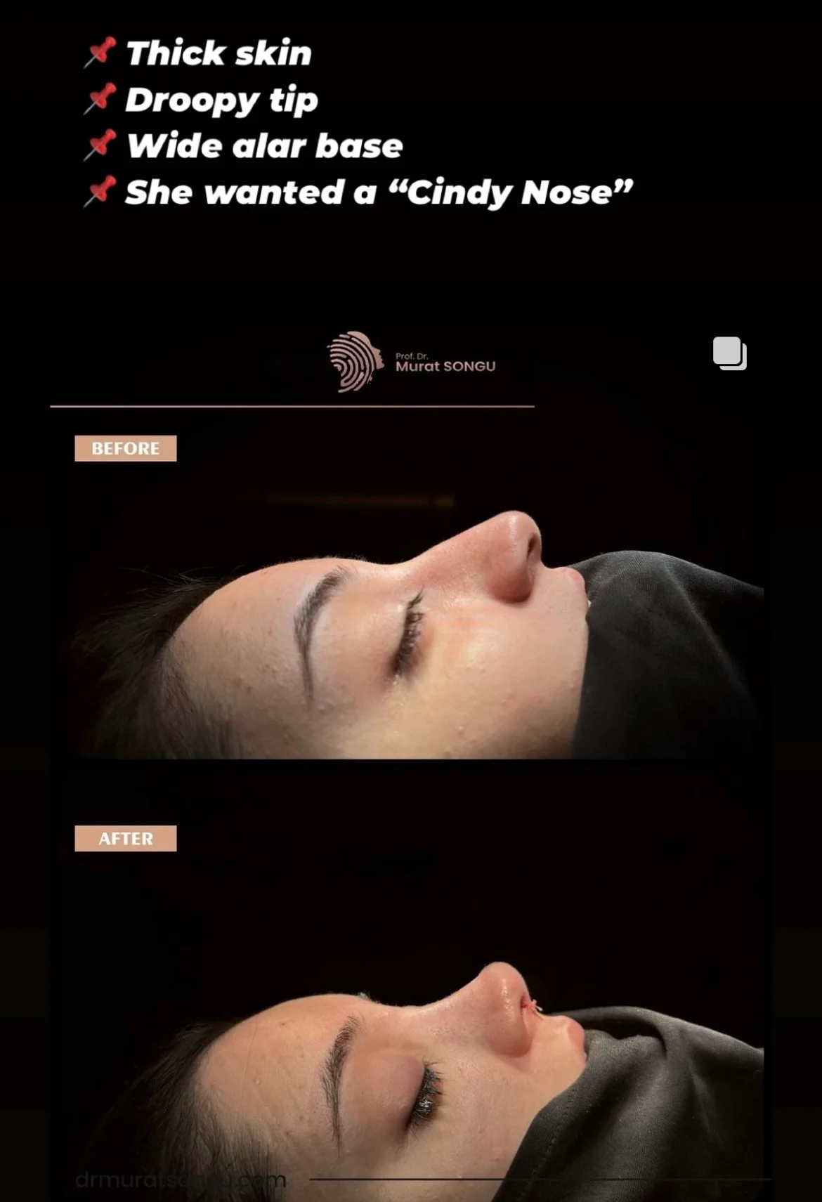 Rhinoplastik för Tjock Hud Före- och Efterbilder