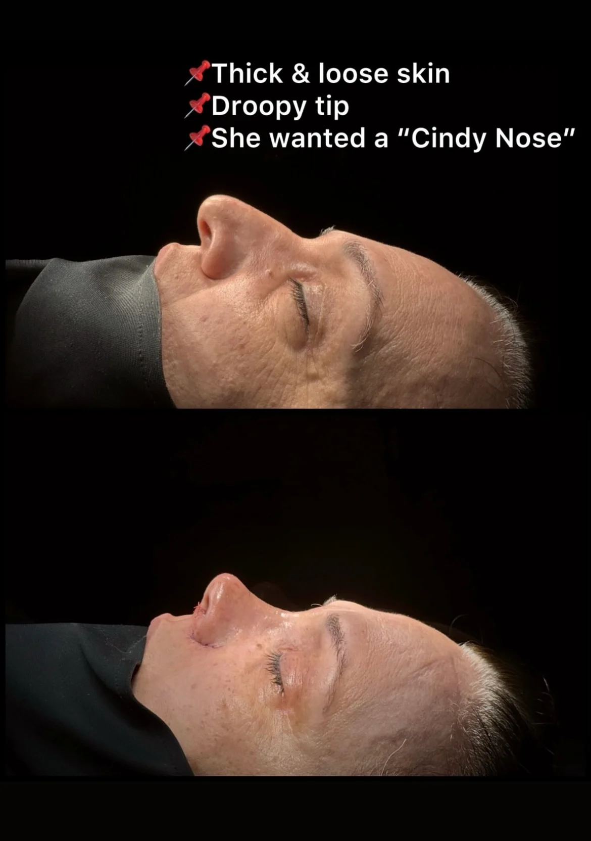 Rhinoplastik för Tjock Hud Före- och Efterbilder