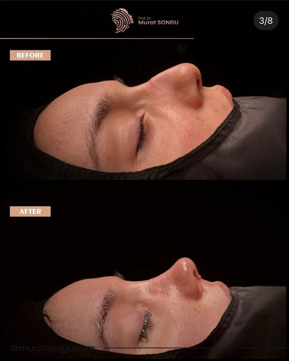 Rhinoplastik för Tjock Hud Före- och Efterbilder