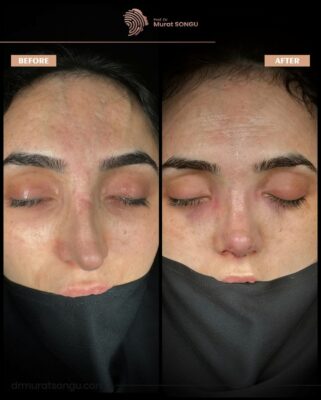 Case Study: Rhinoplasty for the Greek Nose