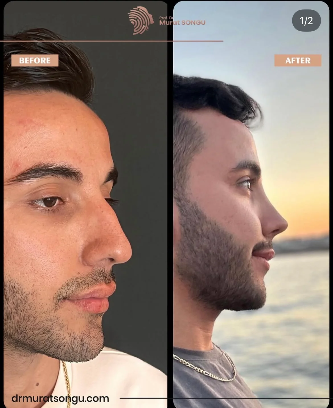 Rinoplastia Antes & Depois Rinoplastia Antes & Depois