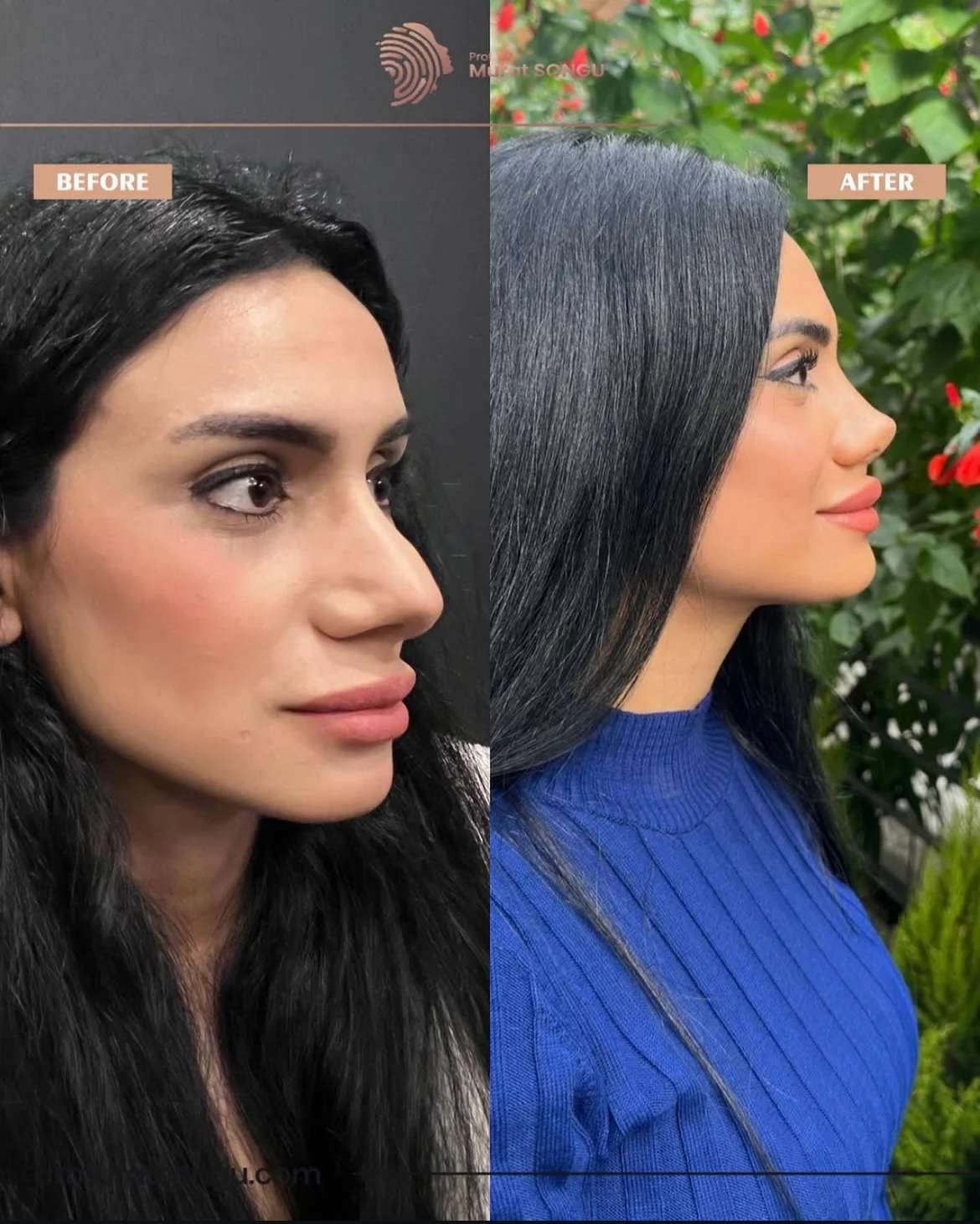 Rinoplastia Antes & Depois Rinoplastia Antes & Depois