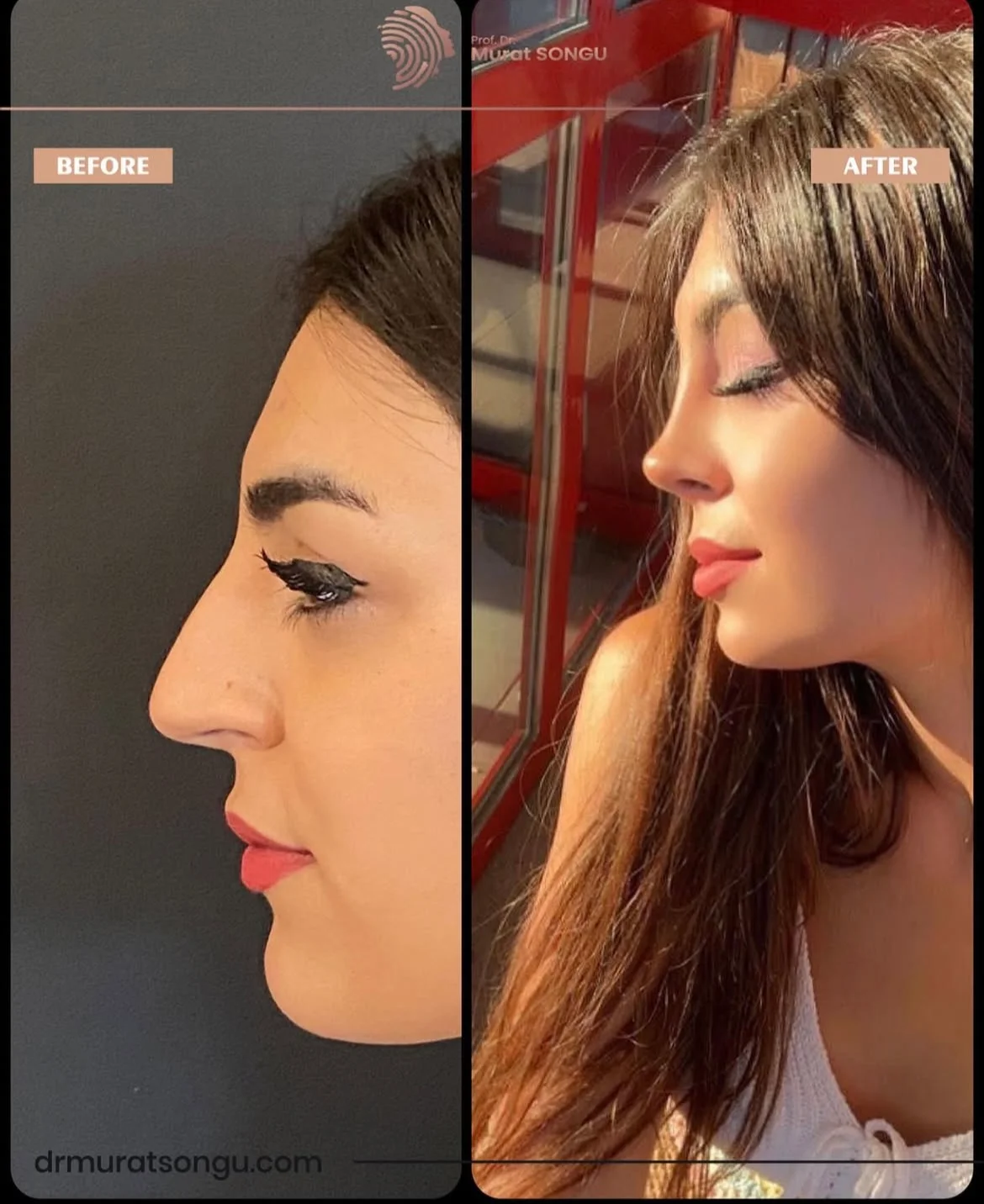 Rinoplastia Antes & Depois Rinoplastia Antes & Depois