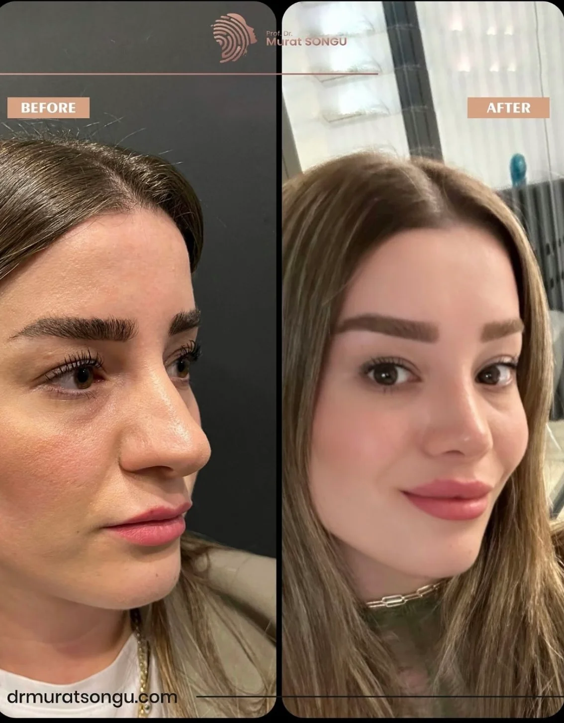 Rinoplastia Antes & Depois Rinoplastia Antes & Depois