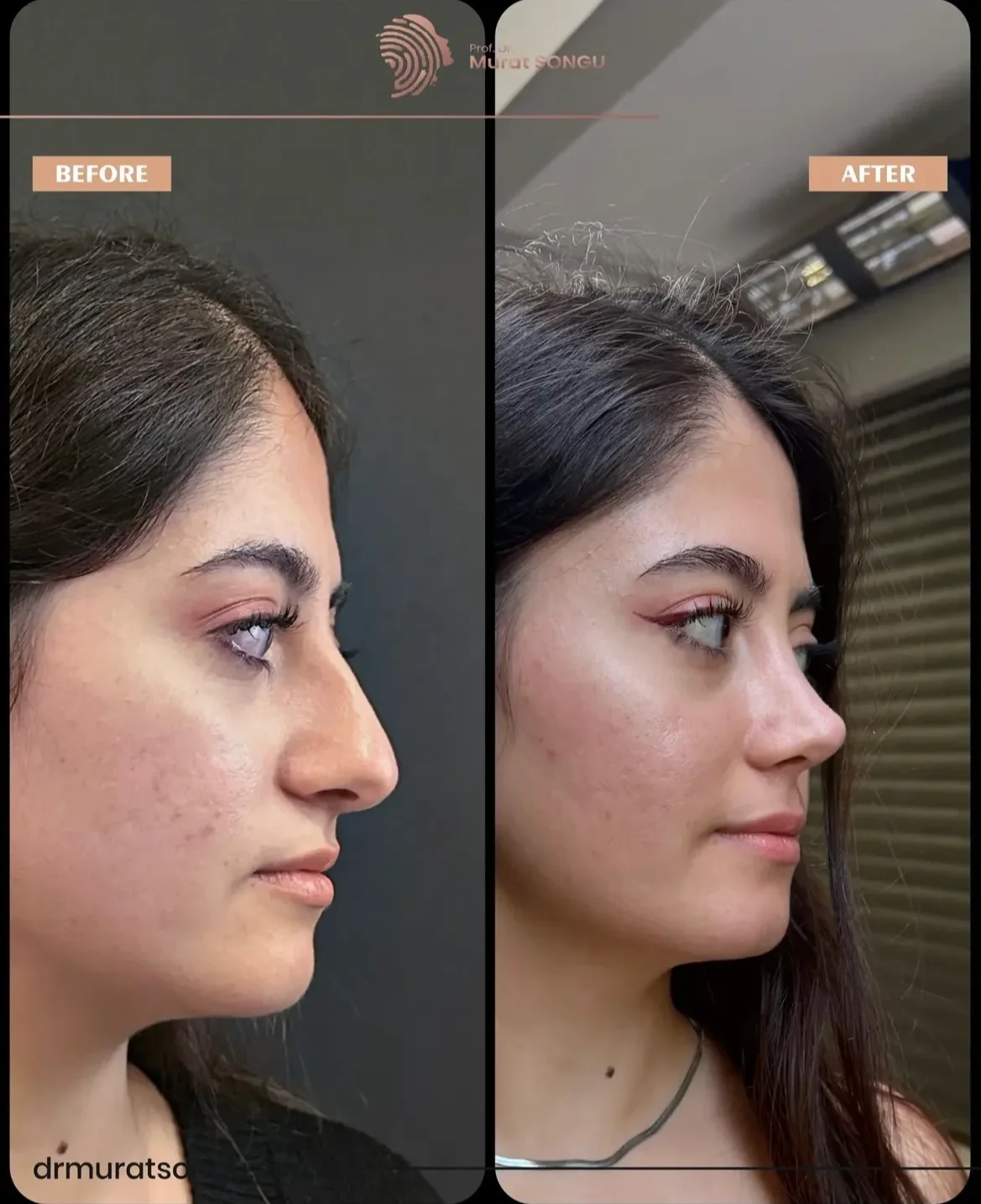 Rinoplastia Antes & Depois Rinoplastia Antes & Depois