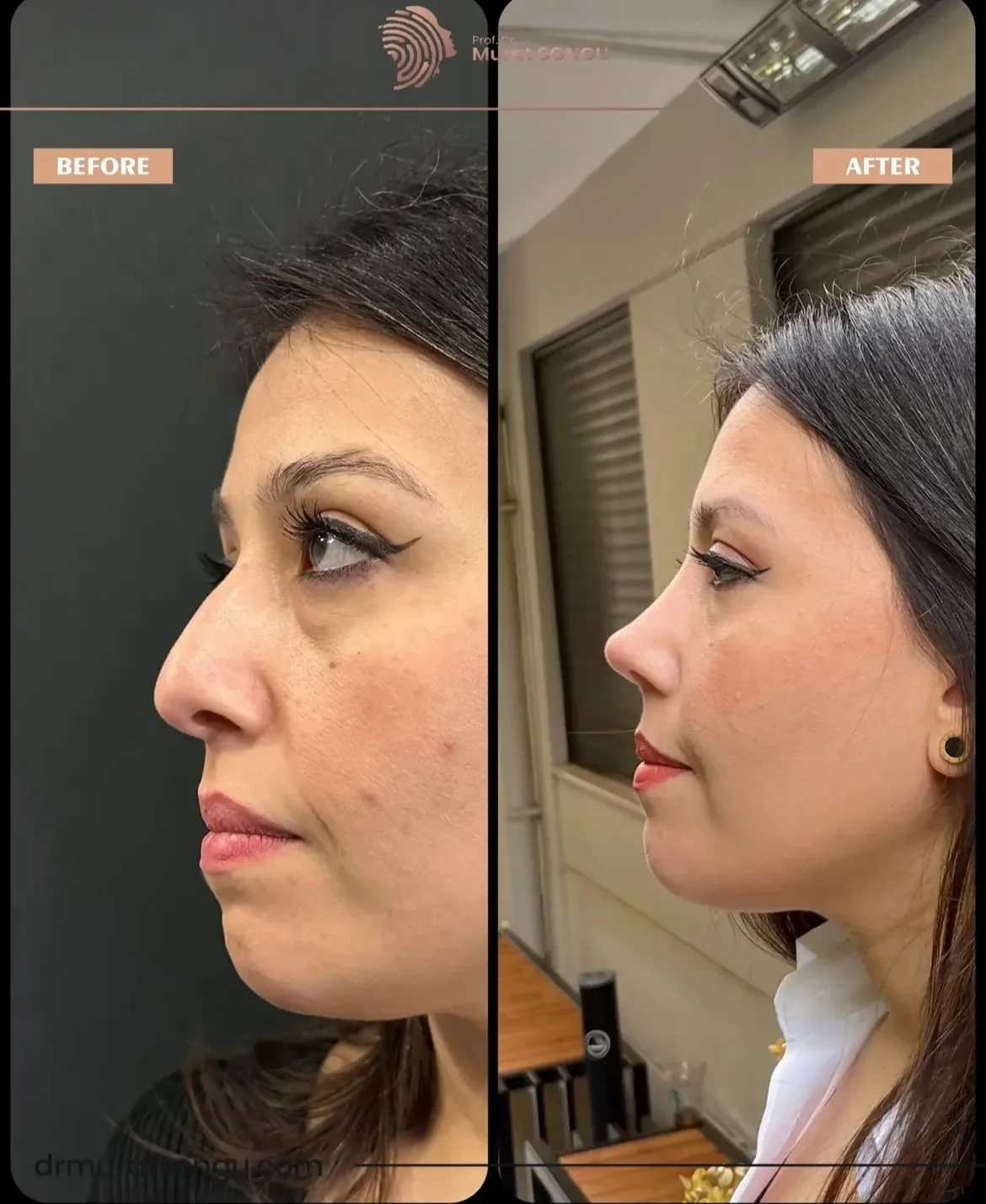 Rinoplastia Antes & Depois Rinoplastia Antes & Depois
