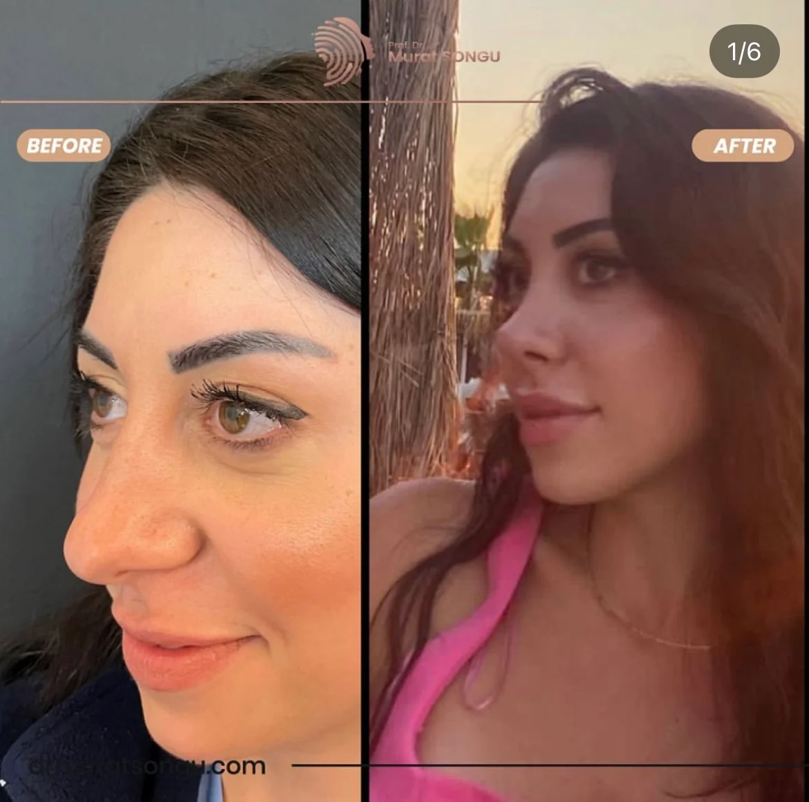 Rinoplastia Antes & Depois Rinoplastia Antes & Depois