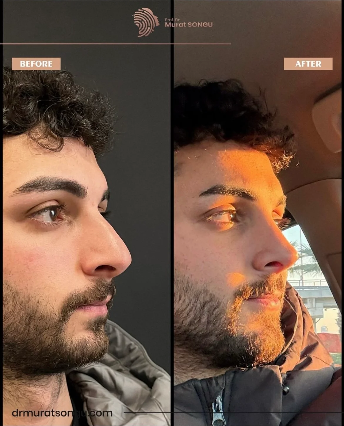 Rinoplastia Antes & Depois Rinoplastia Antes & Depois