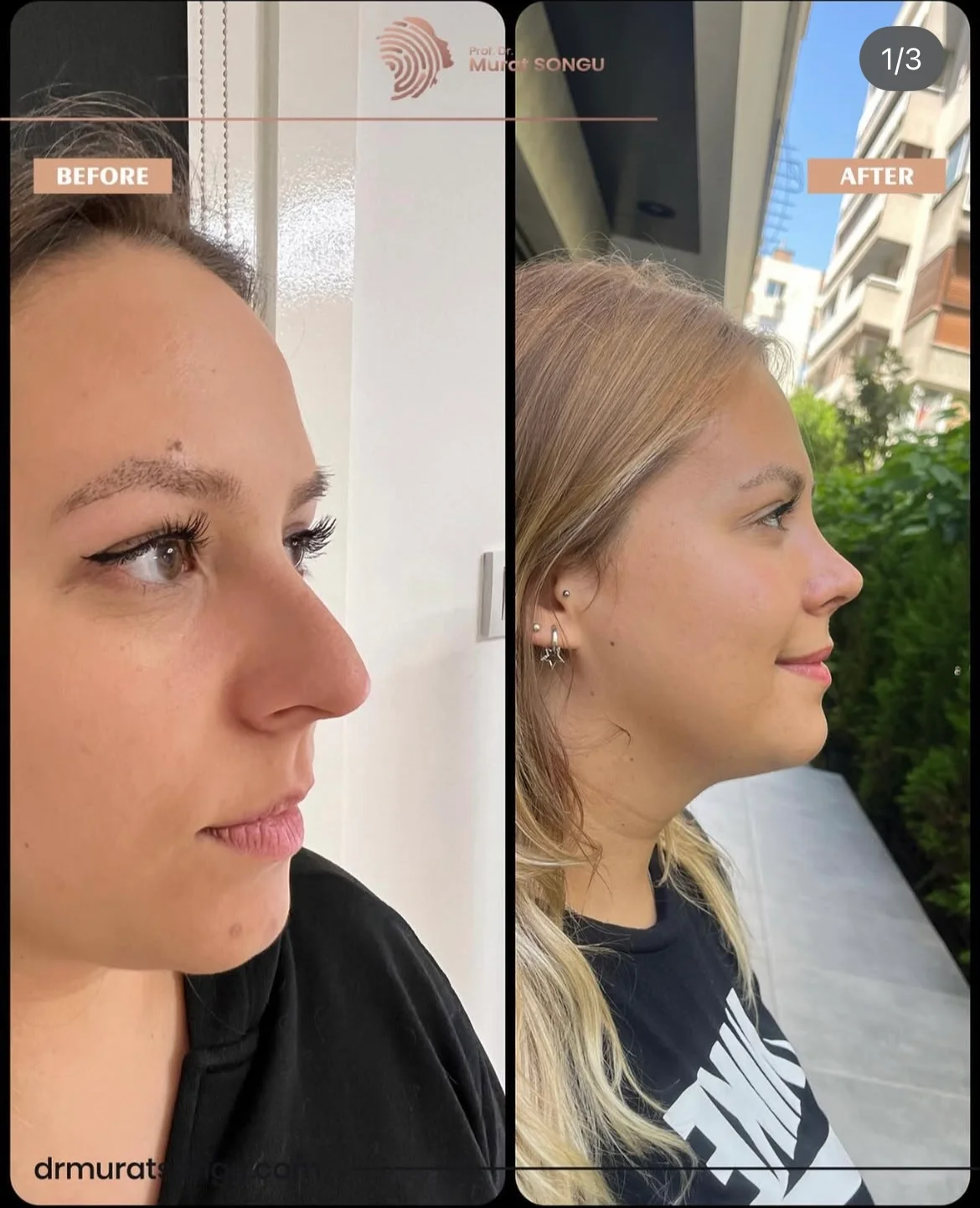 Rinoplastia Antes & Depois Rinoplastia Antes & Depois