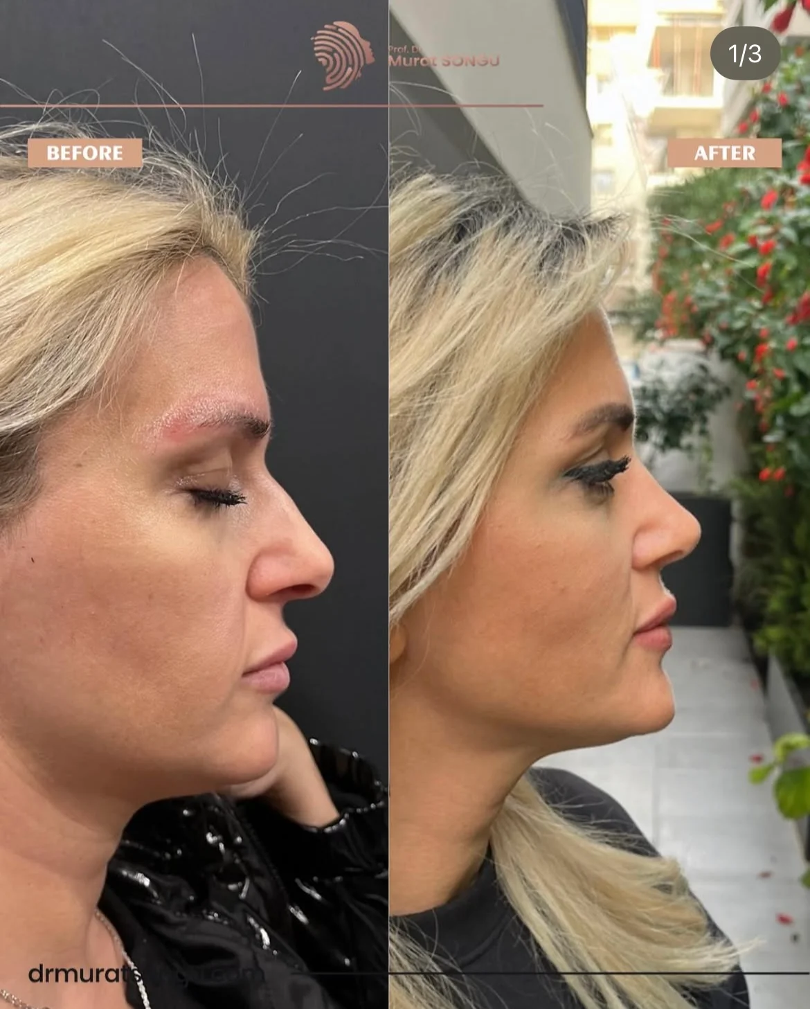 Rinoplastia Antes & Depois Rinoplastia Antes & Depois