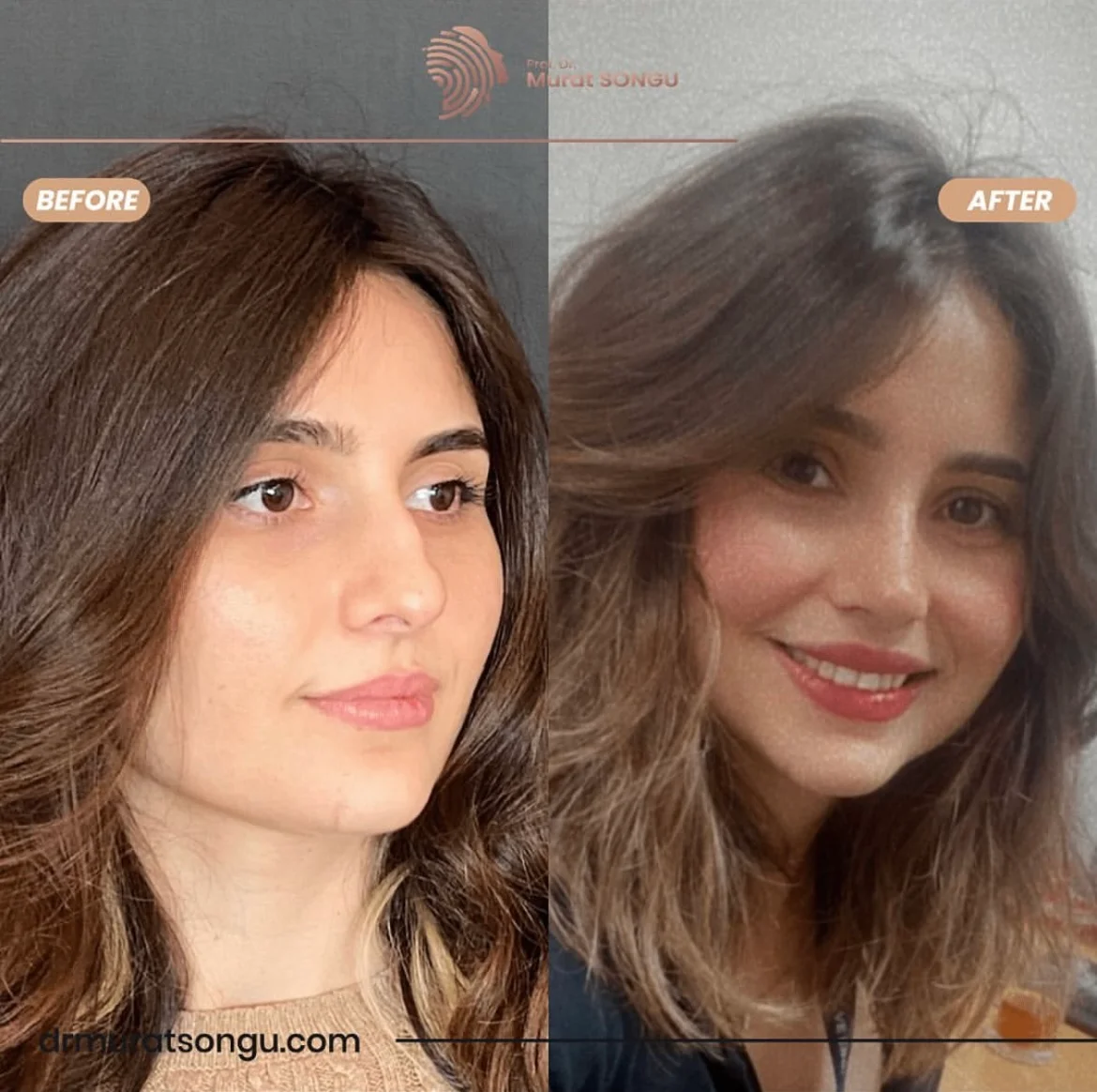 Rinoplastia Antes & Depois Rinoplastia Antes & Depois