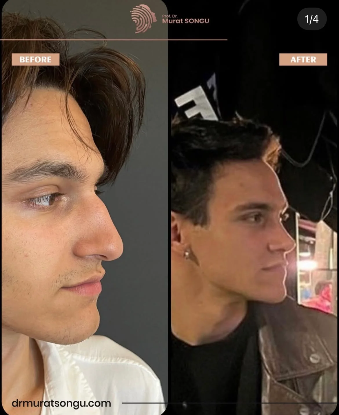 Rinoplastia Antes & Depois Rinoplastia Antes & Depois