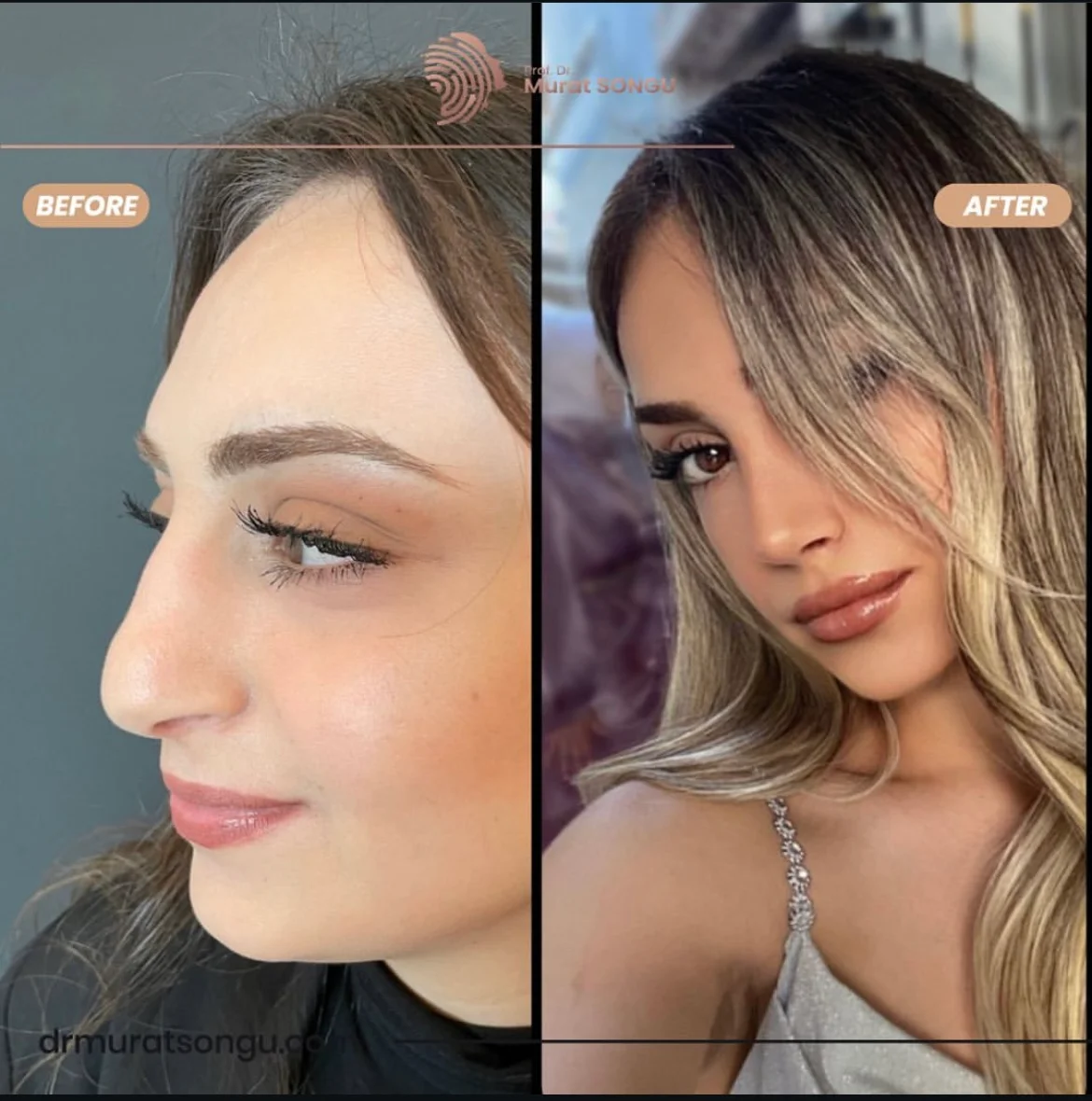 Rinoplastia Antes & Depois Rinoplastia Antes & Depois