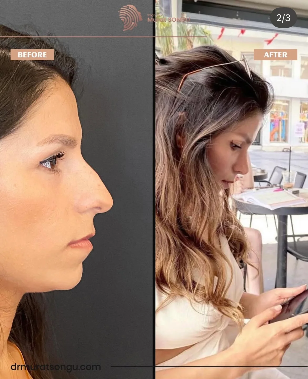 Rinoplastia Antes & Depois Rinoplastia Antes & Depois