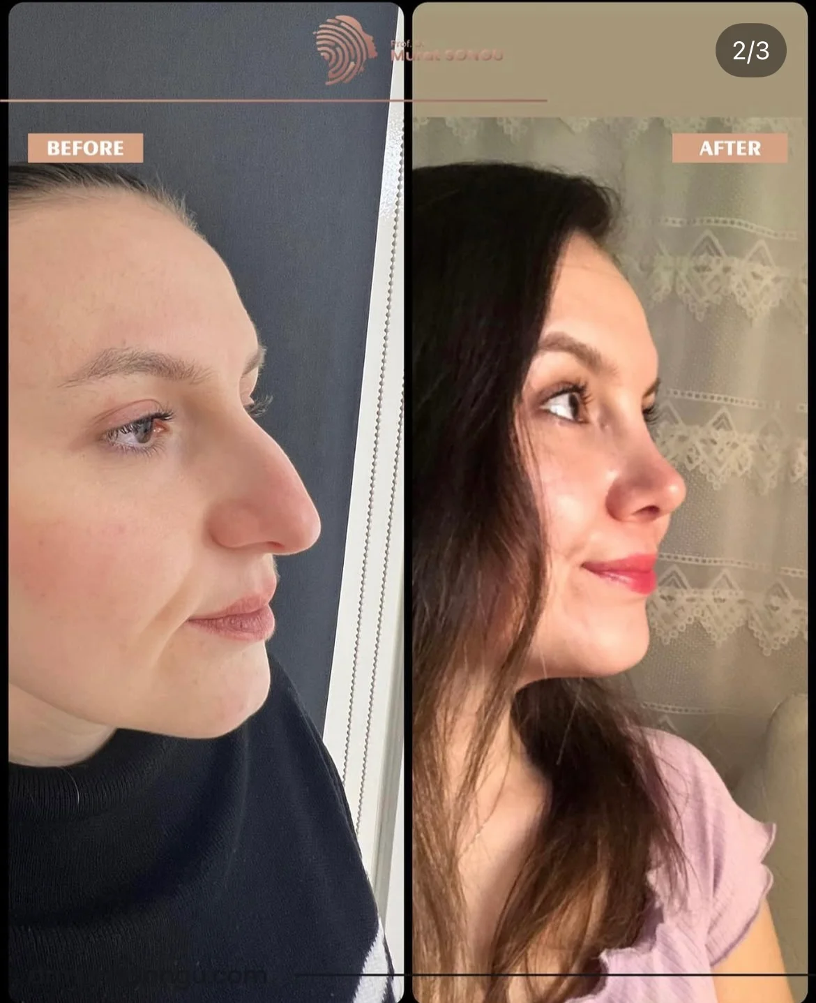 Rinoplastia Antes & Depois Rinoplastia Antes & Depois