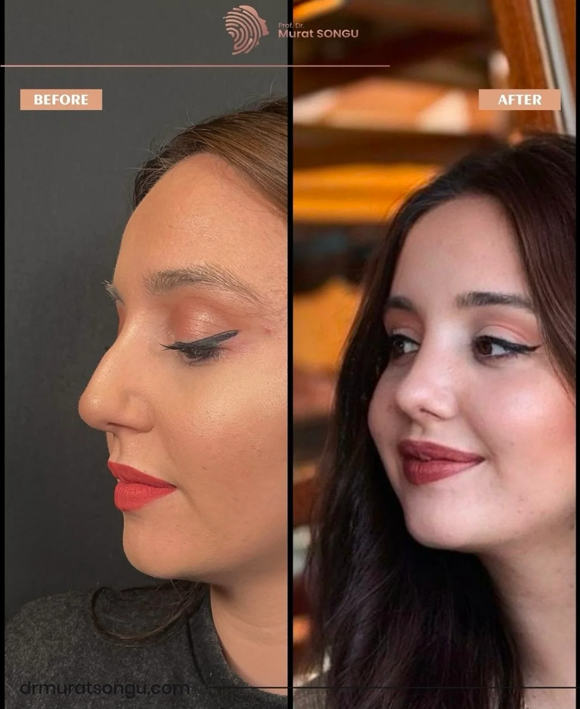 Rinoplastia Antes & Depois Rinoplastia Antes & Depois