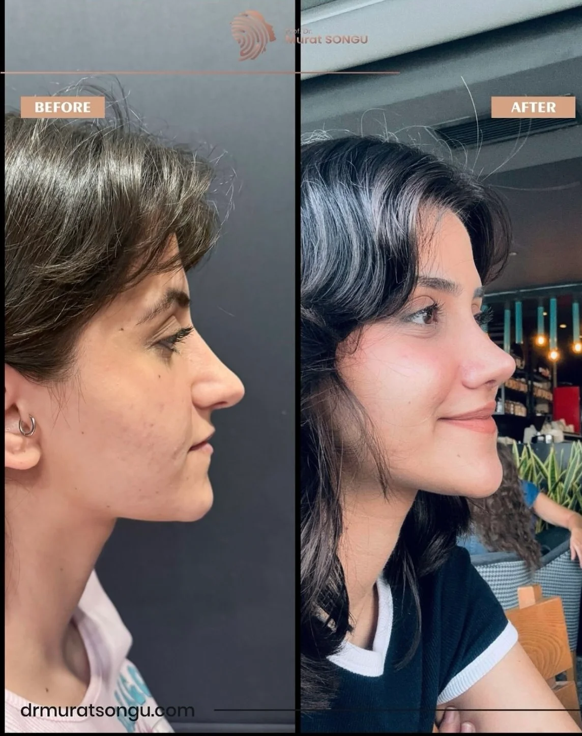 Rinoplastia Antes & Depois Rinoplastia Antes & Depois