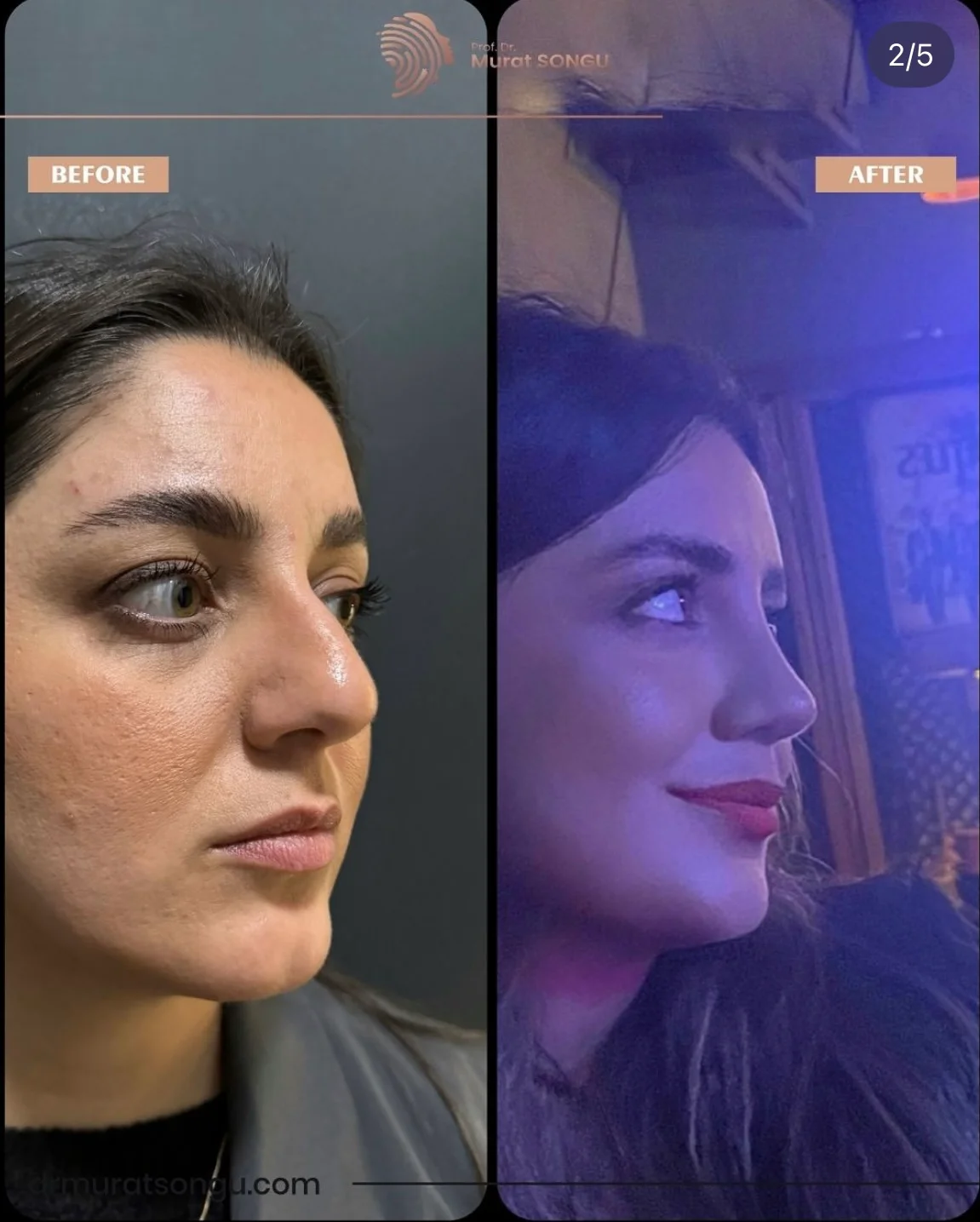 Rinoplastia Antes & Depois Rinoplastia Antes & Depois