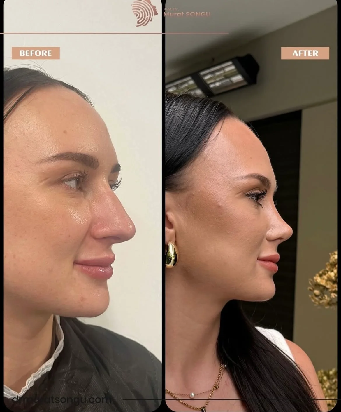 Rinoplastia Antes & Depois Rinoplastia Antes & Depois