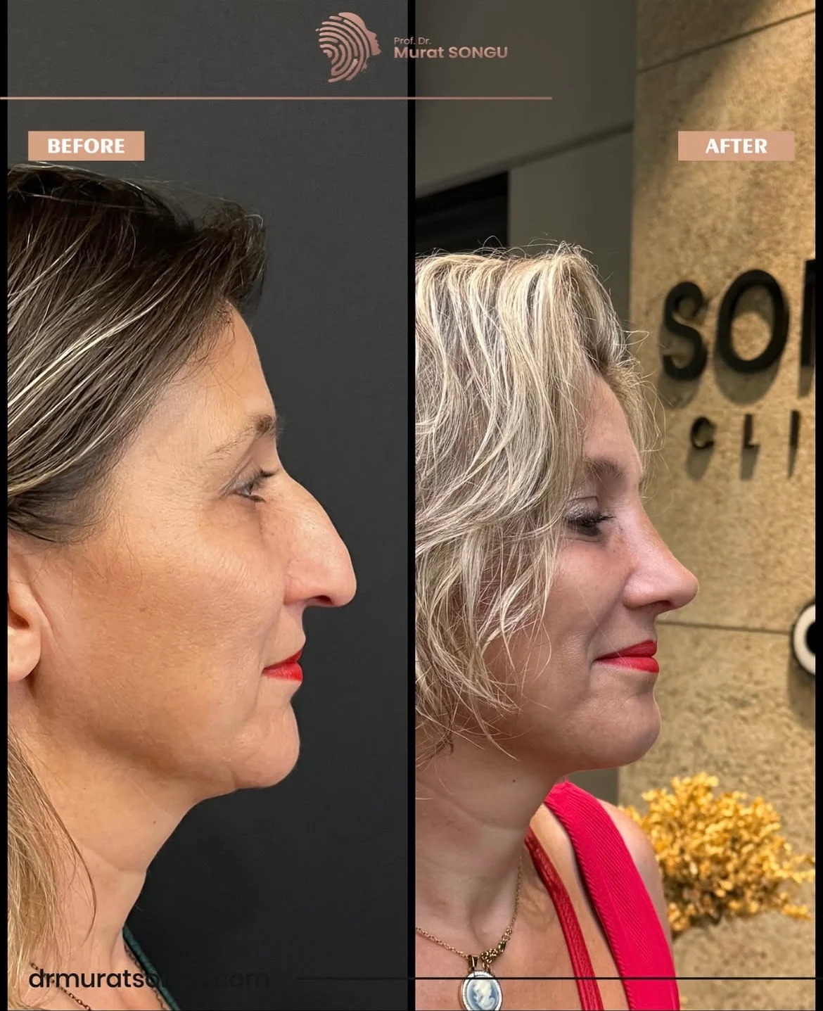 Rinoplastia Antes & Depois Rinoplastia Antes & Depois