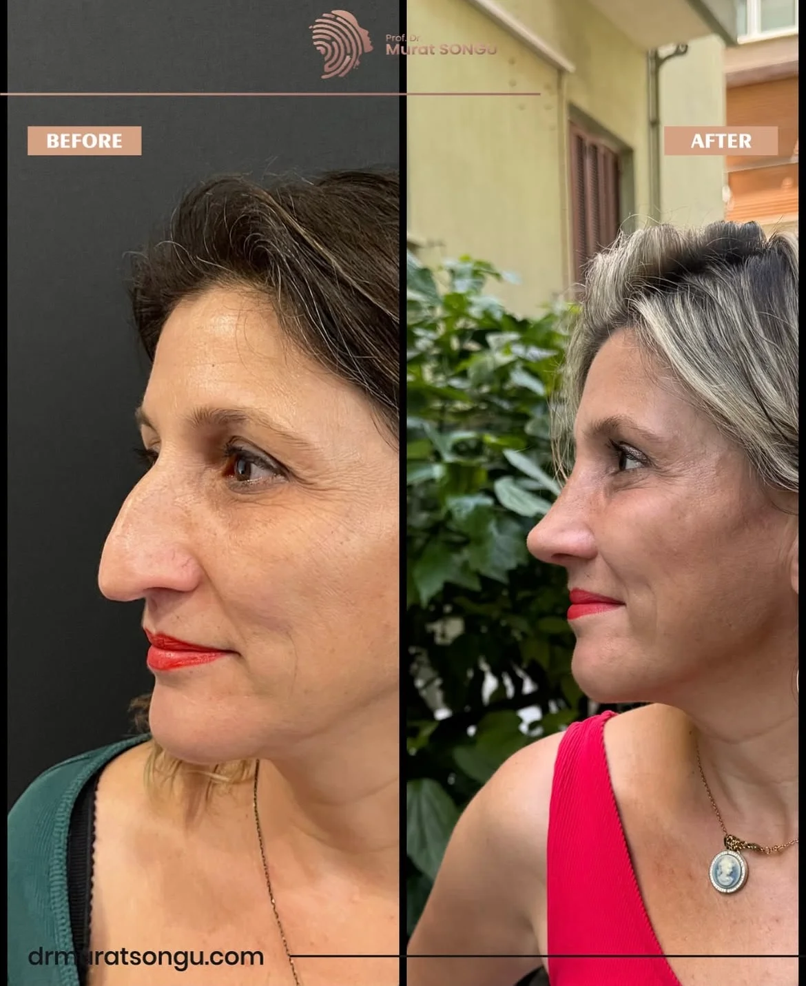 Rinoplastia Antes & Depois Rinoplastia Antes & Depois