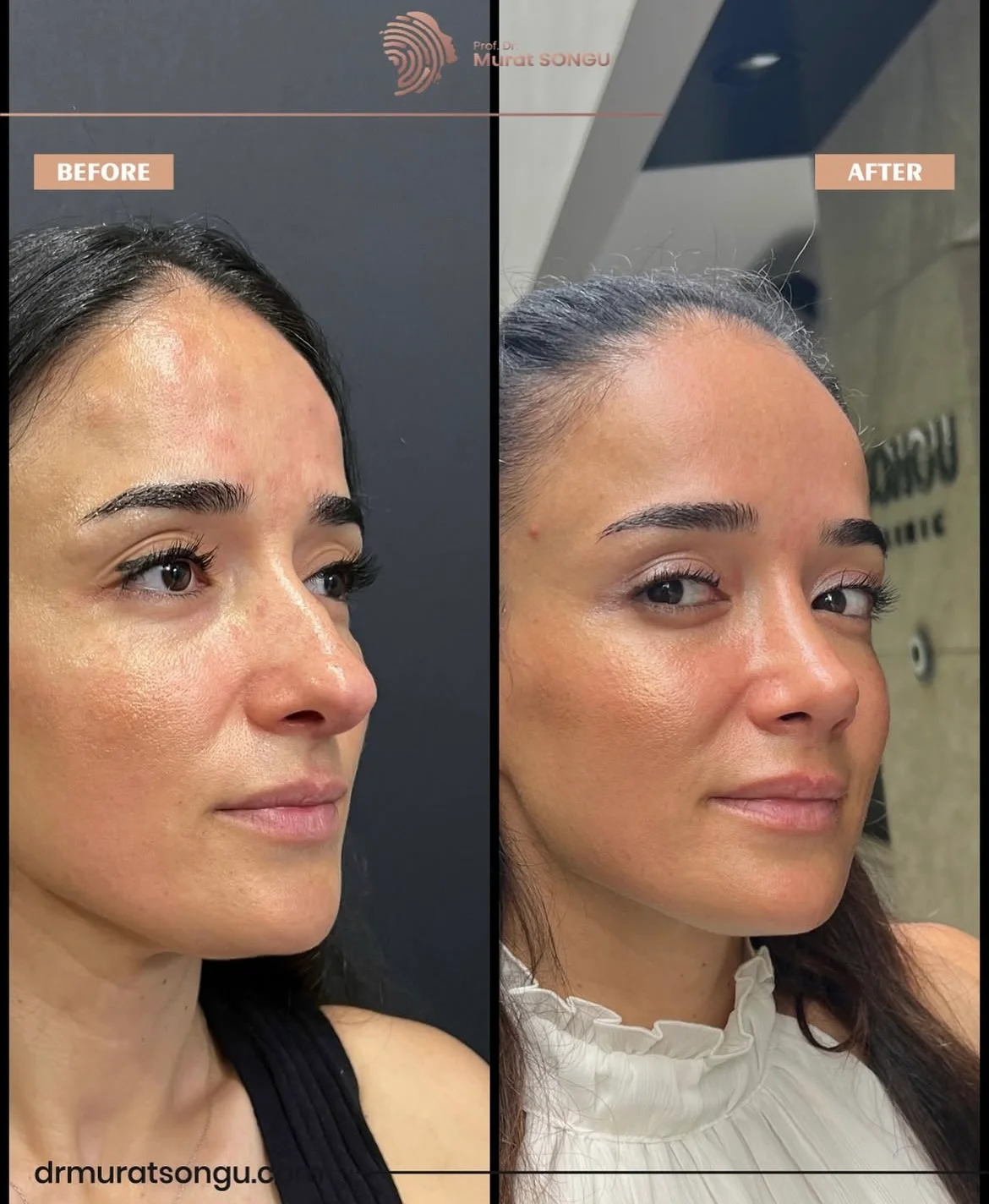 Rinoplastia Antes & Depois Rinoplastia Antes & Depois