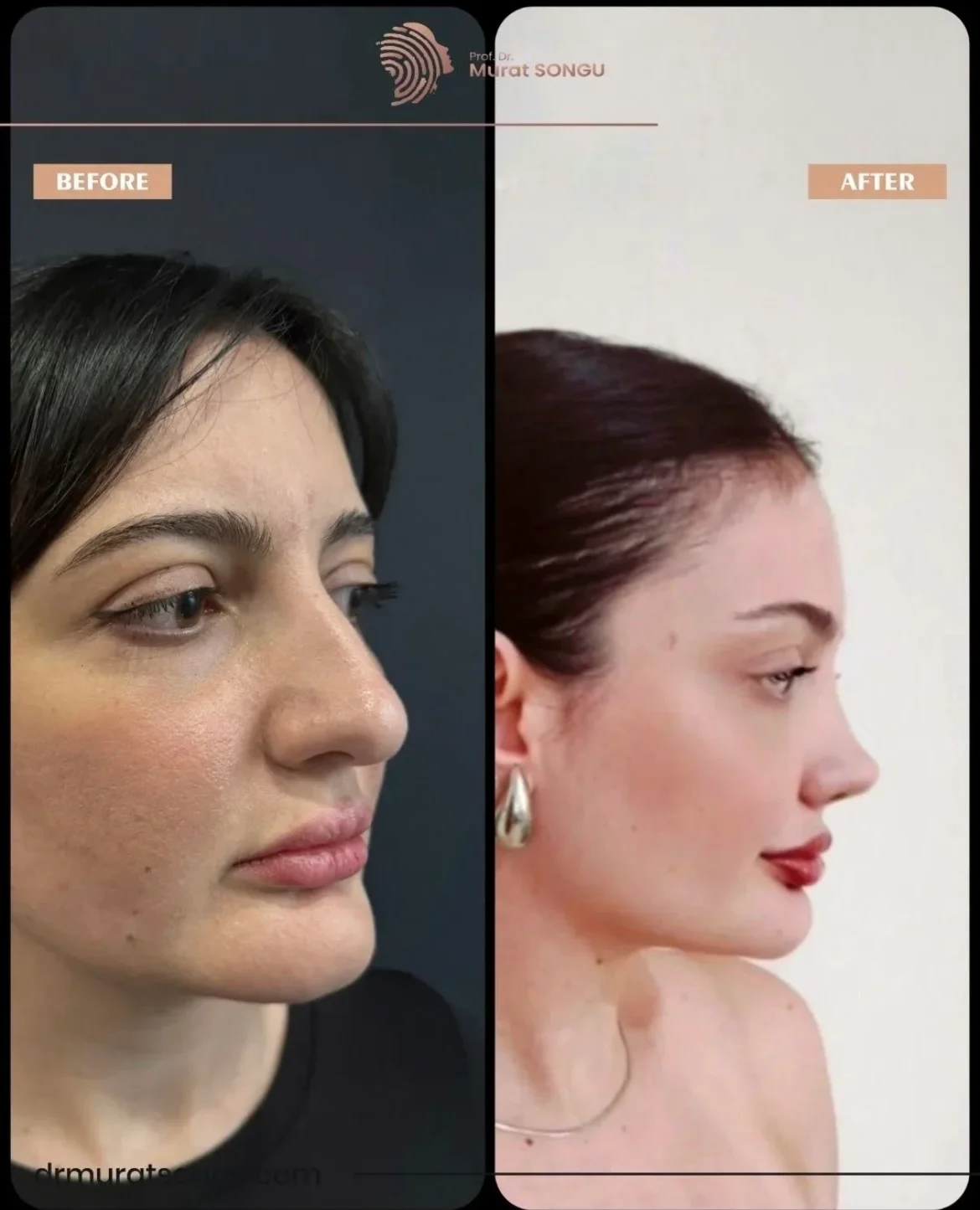 Rinoplastia Antes & Depois Rinoplastia Antes & Depois