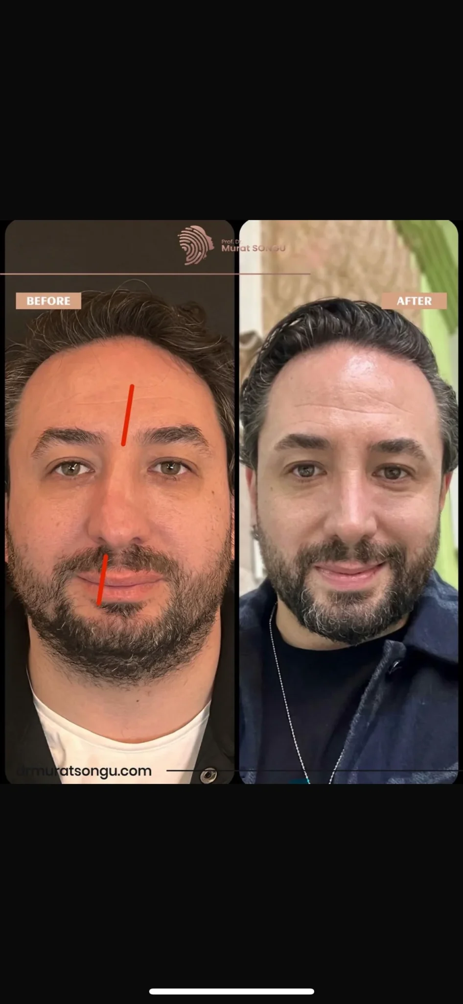 Rinoplastia Antes & Depois Rinoplastia Antes & Depois