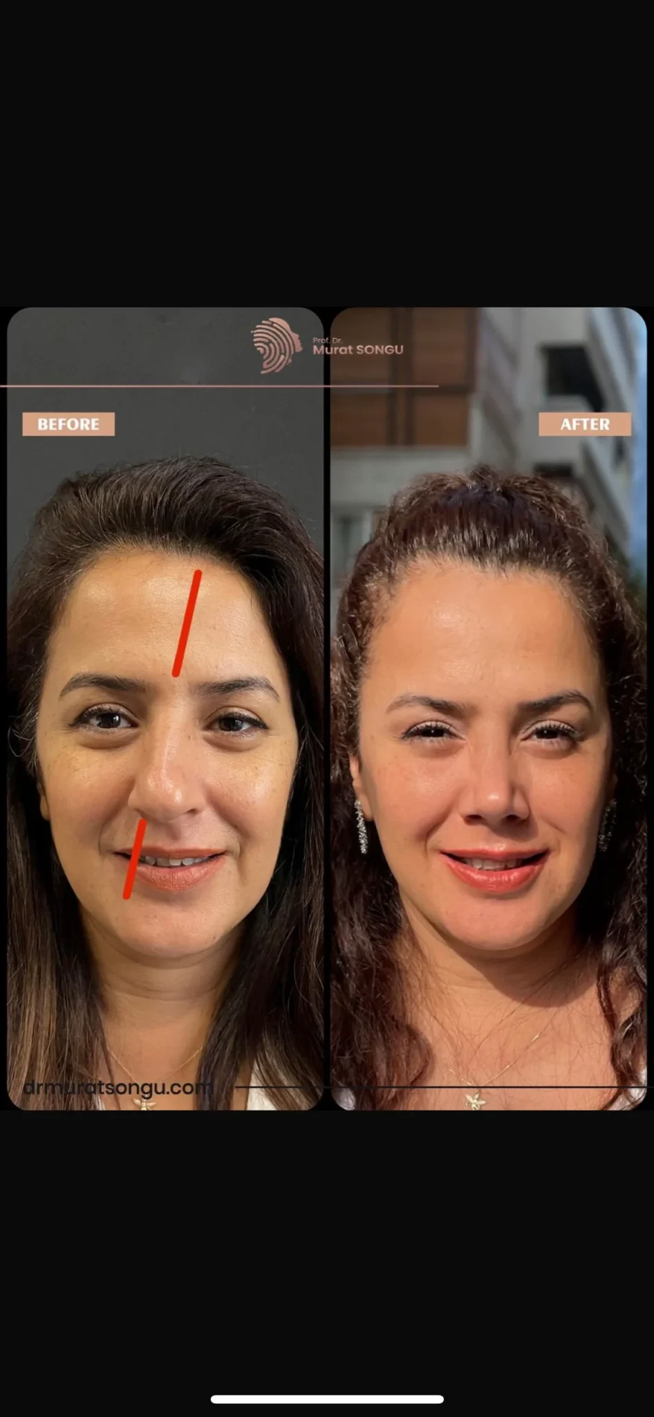 Rinoplastia Antes & Depois Rinoplastia Antes & Depois