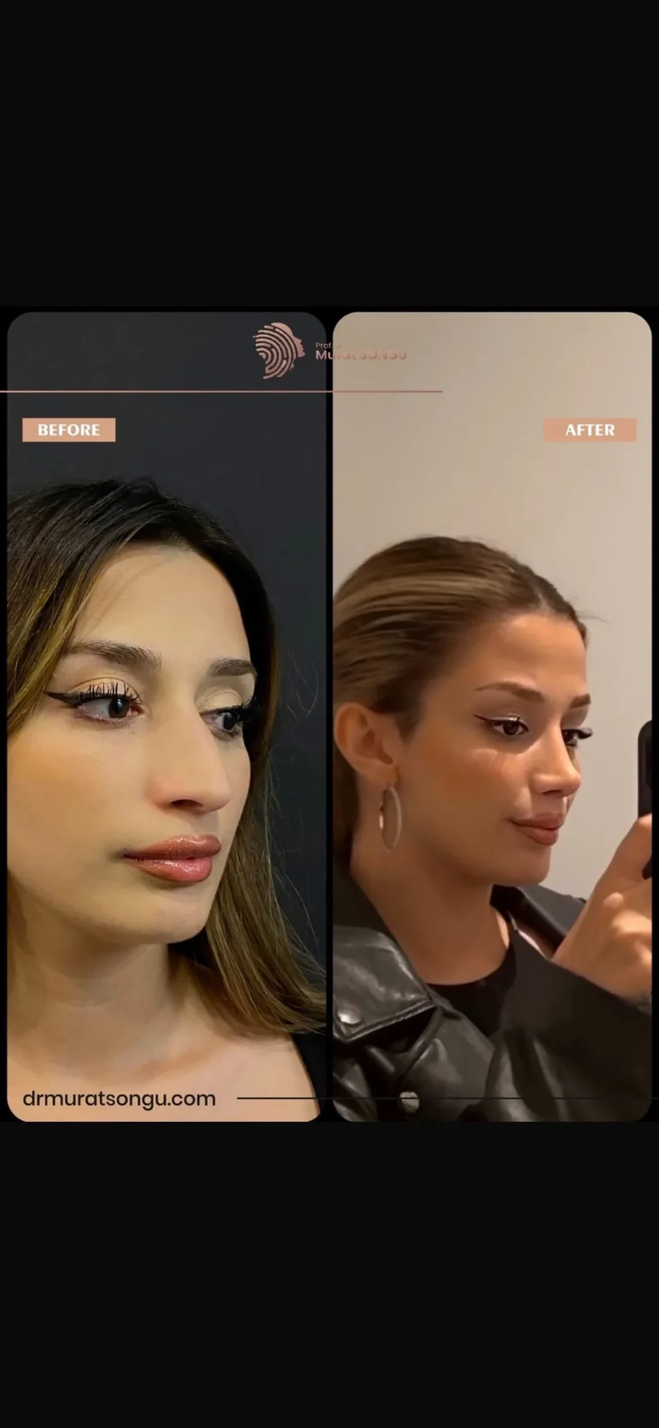 Rinoplastia Antes & Depois Rinoplastia Antes & Depois