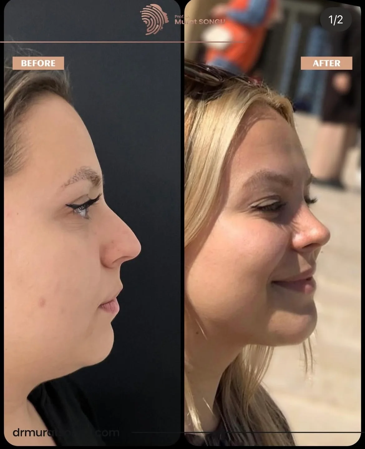 Rinoplastia Antes & Depois Rinoplastia Antes & Depois