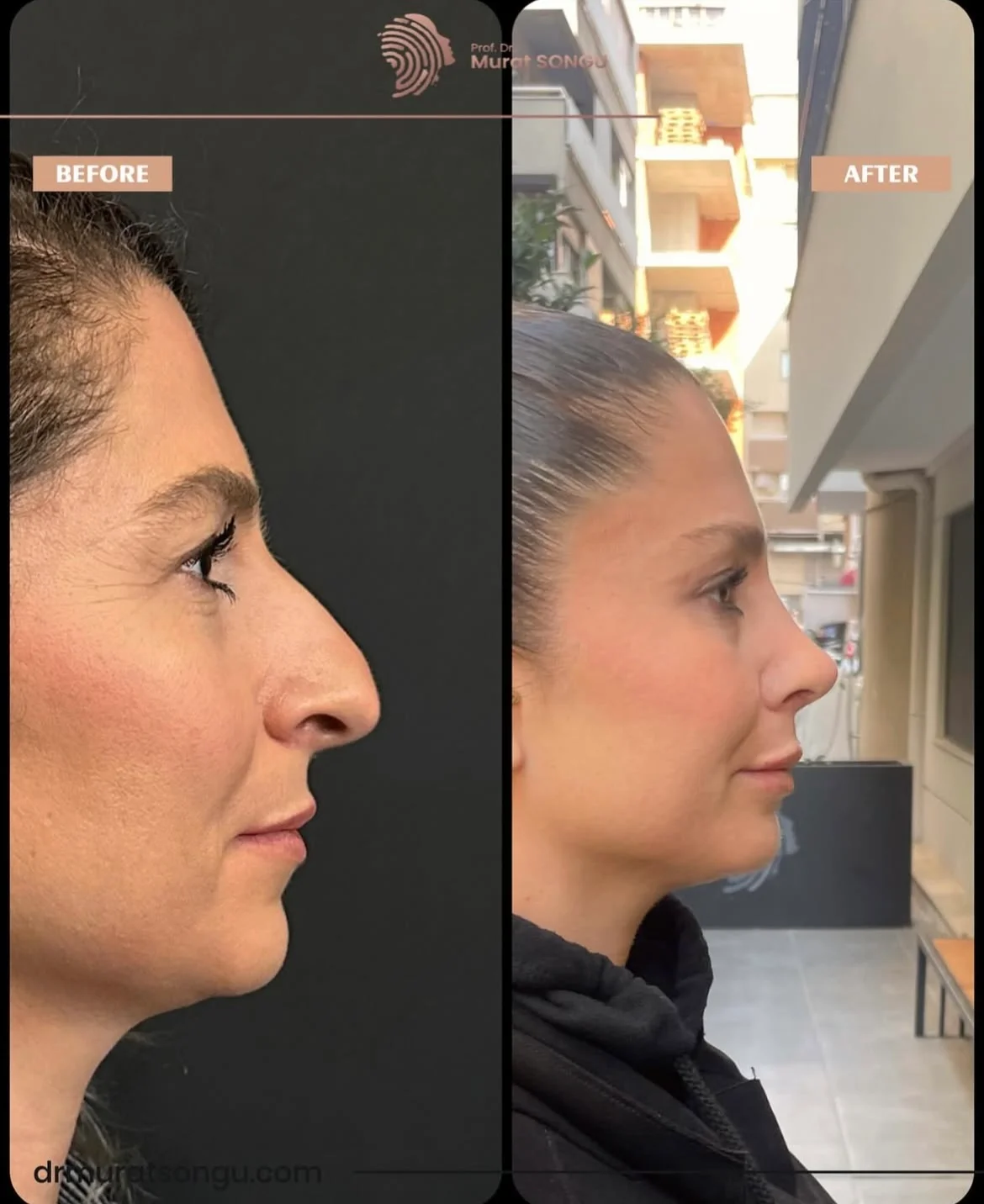 Rinoplastia Antes & Depois Rinoplastia Antes & Depois