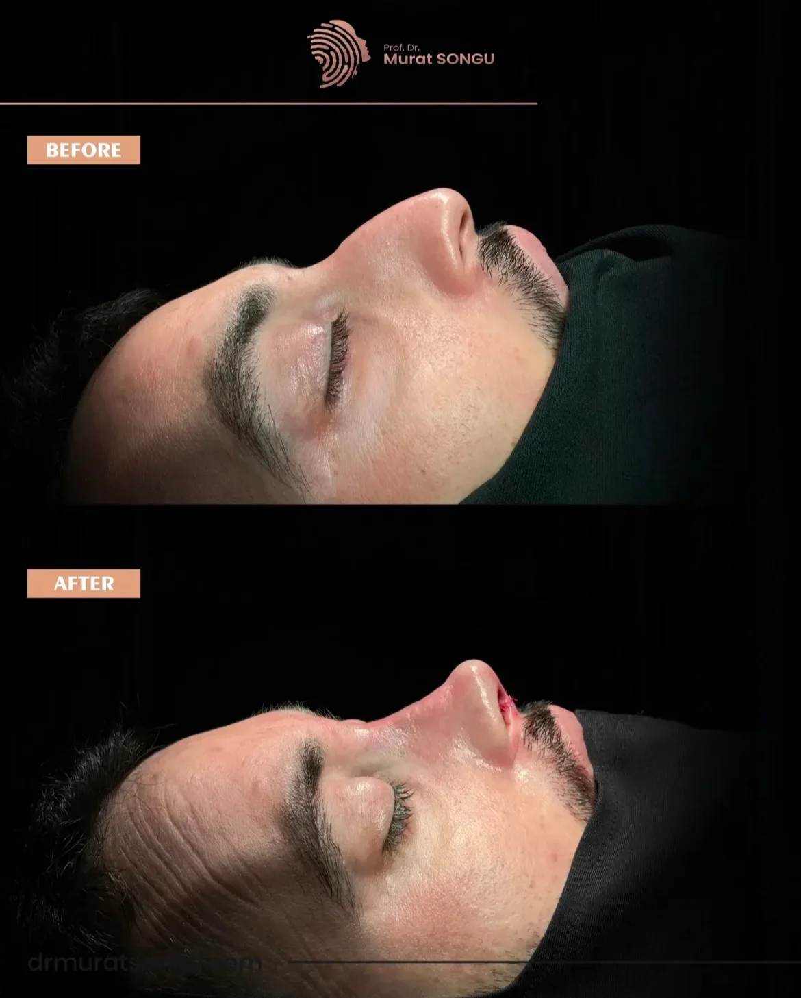 Rinoplastia Masculina Antes y Después Rinoplastia Masculina Antes y Después