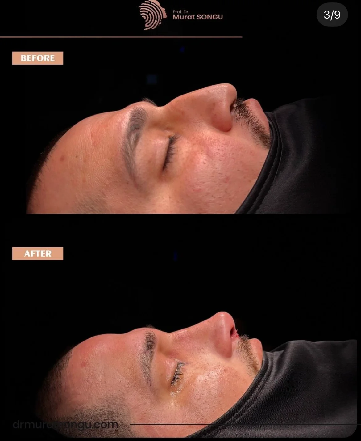 Rinoplastia Masculina Antes y Después Rinoplastia Masculina Antes y Después