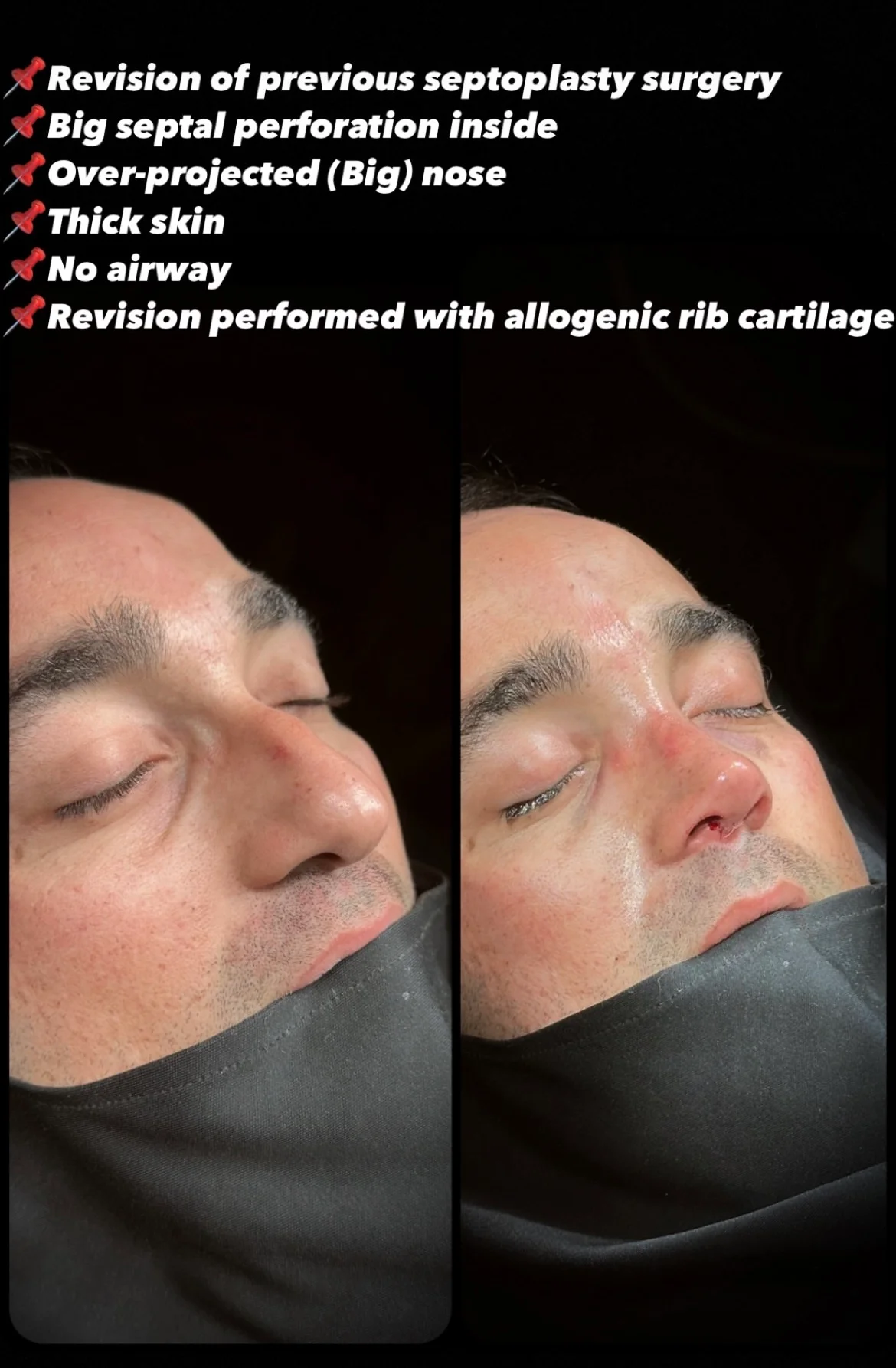 Rinoplastia Masculina Antes y Después Rinoplastia Masculina Antes y Después