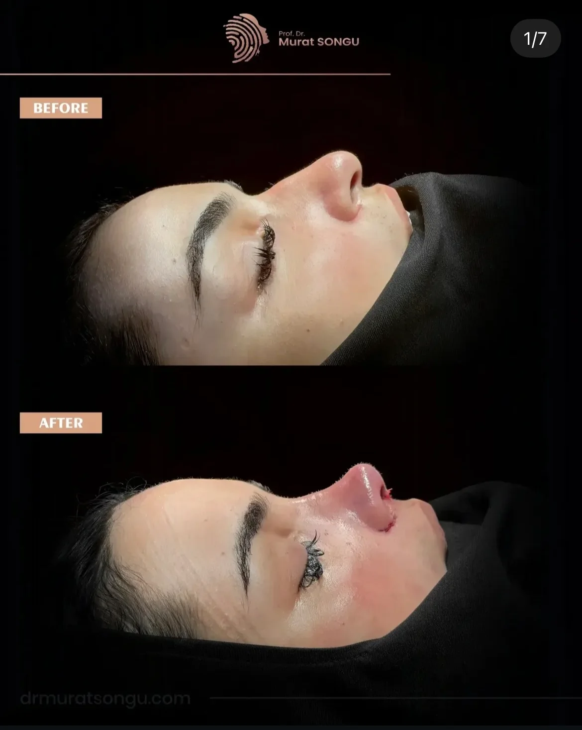 Rinoplastia com Pele Espessa Antes & Depois