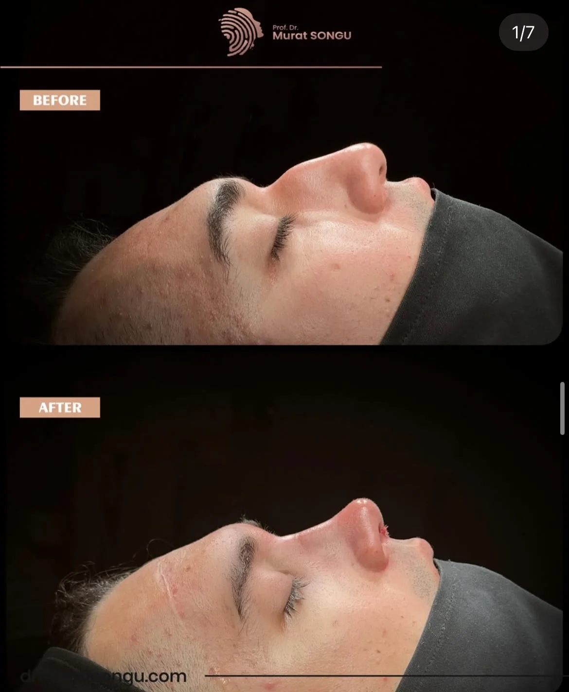 Rinoplastia com Pele Espessa Antes & Depois