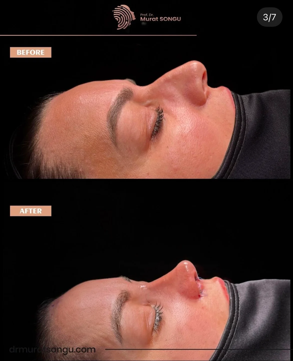 Rinoplastia com Pele Espessa Antes & Depois